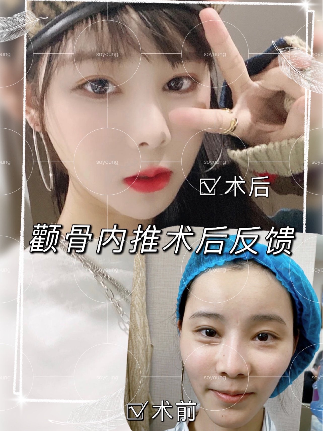 的突兀,轮廓生硬,左右脸型还有比较轻度的不对称感觉,影响正个颜值!