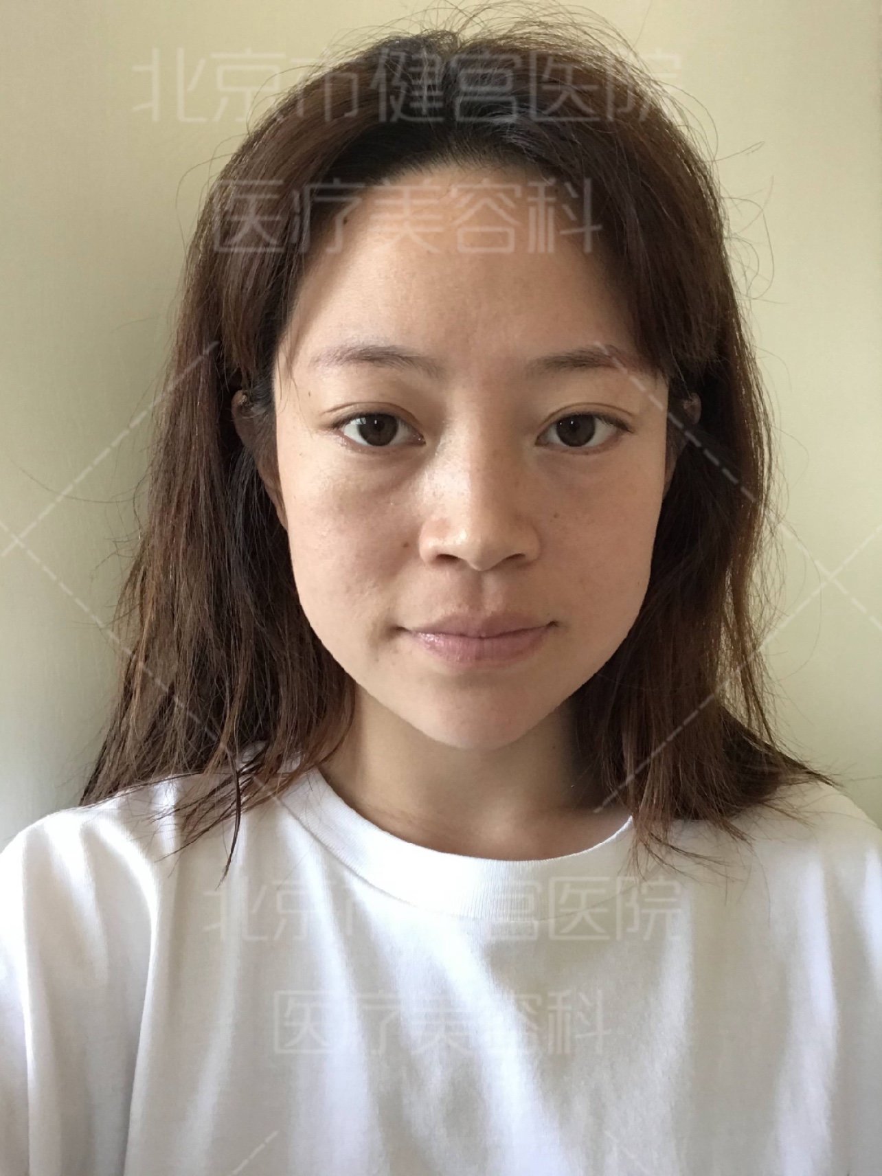 面部松弛下垂,苹果肌下移,可见面部胶原蛋白流失严重_圈子-新氧美容