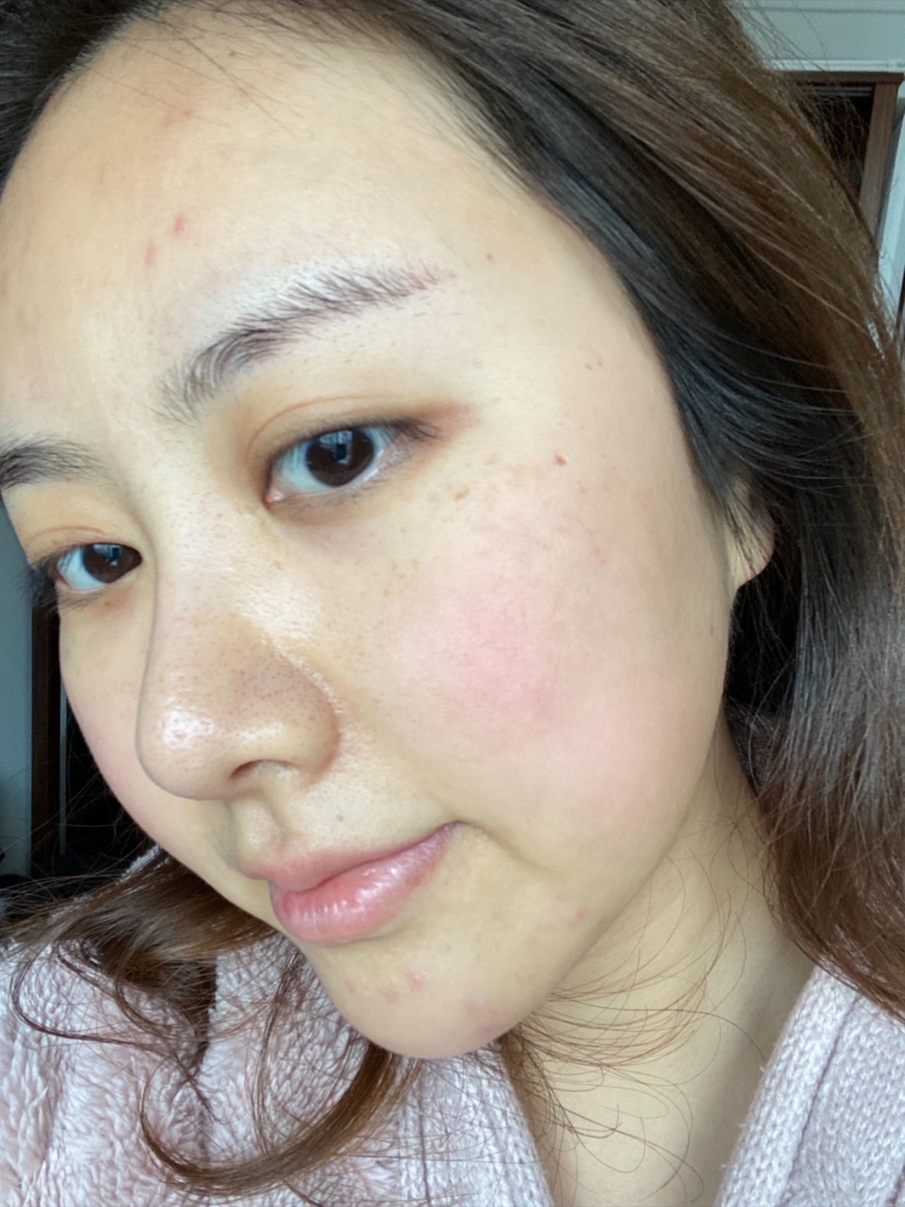 [:163]体验前变美诉求:脸颊泛红,t区毛孔粗大_圈子-新氧美容整形