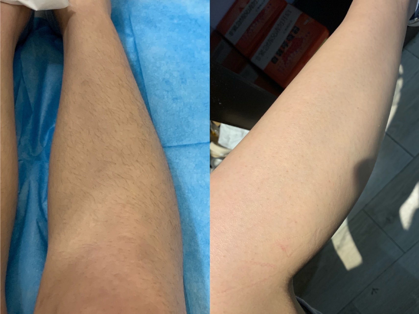 全腿脱毛初体验很开心能成为本次美腿三件套的体验官第_圈子-新氧美容