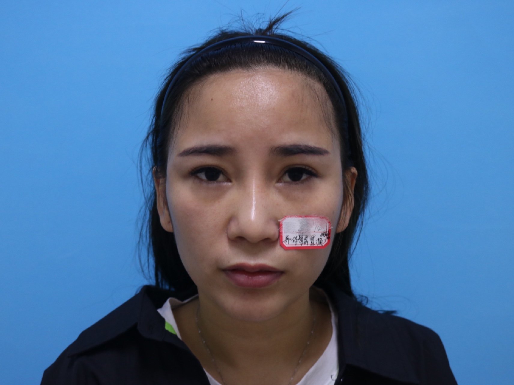 记我的异体骨鼻部多项,半年前其实有在广东那边做过隆鼻_圈子-新氧