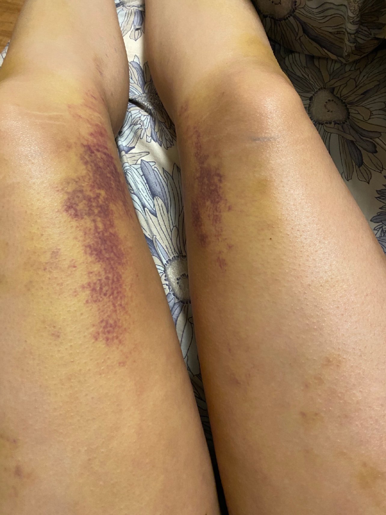 大腿环吸后半个月了,现在走路基本上正常了,触摸还是_圈子-新氧美容