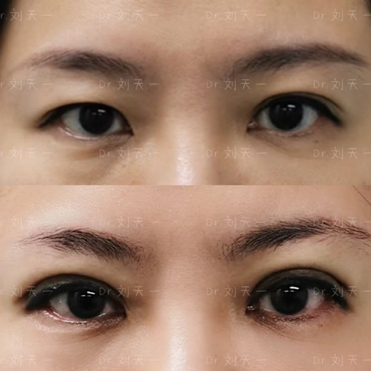 全切双眼皮上睑松弛矫正术后即刻