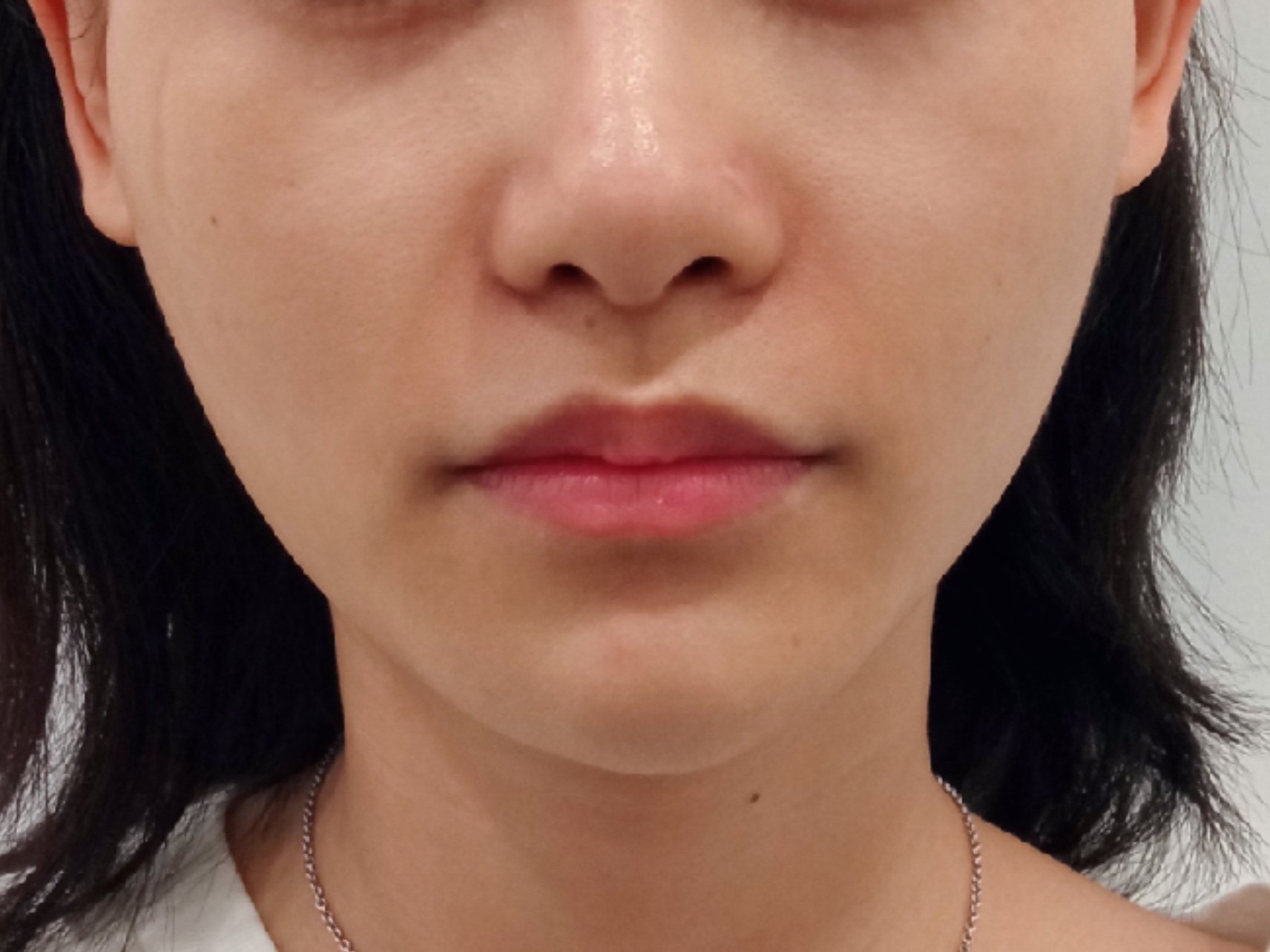 玻尿酸填充鼻基底案例分享#整形医生案例大赏