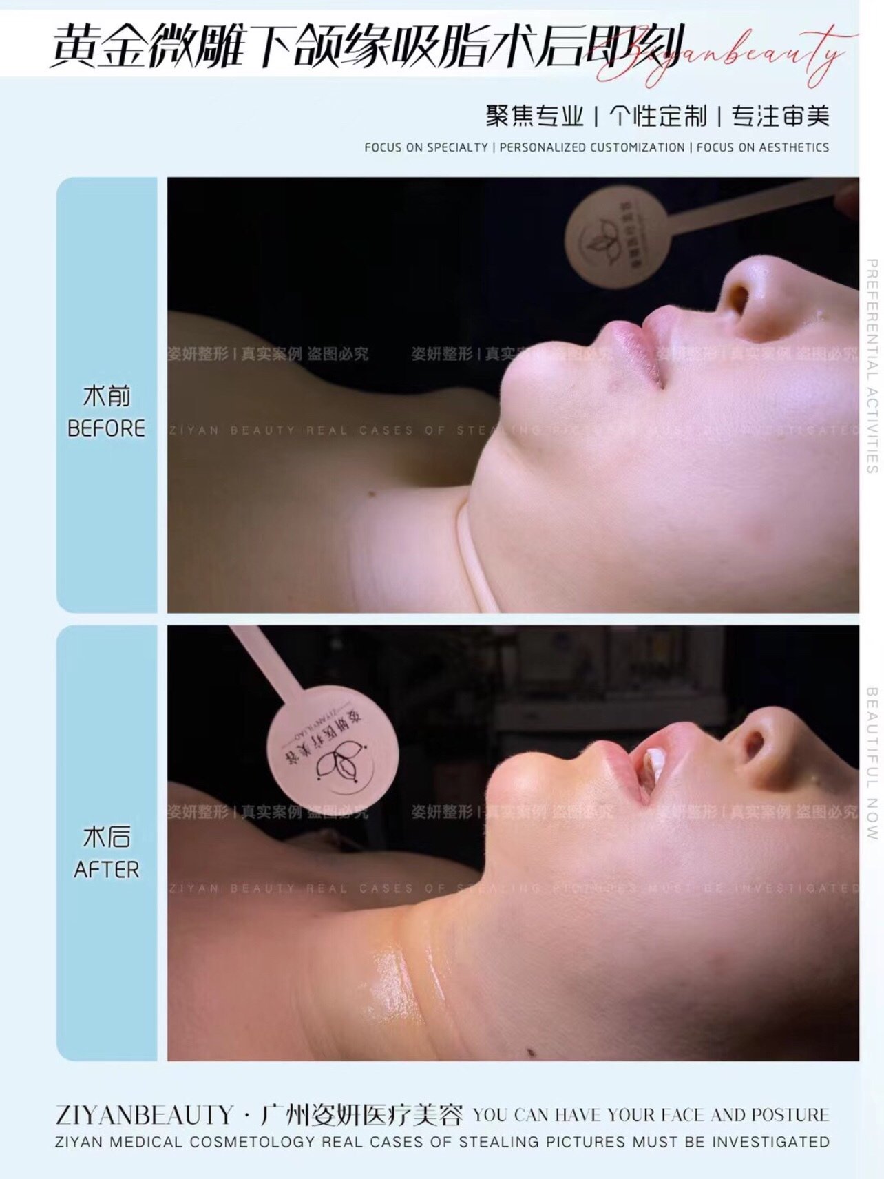 下颌缘吸脂术后即刻双下巴吸脂