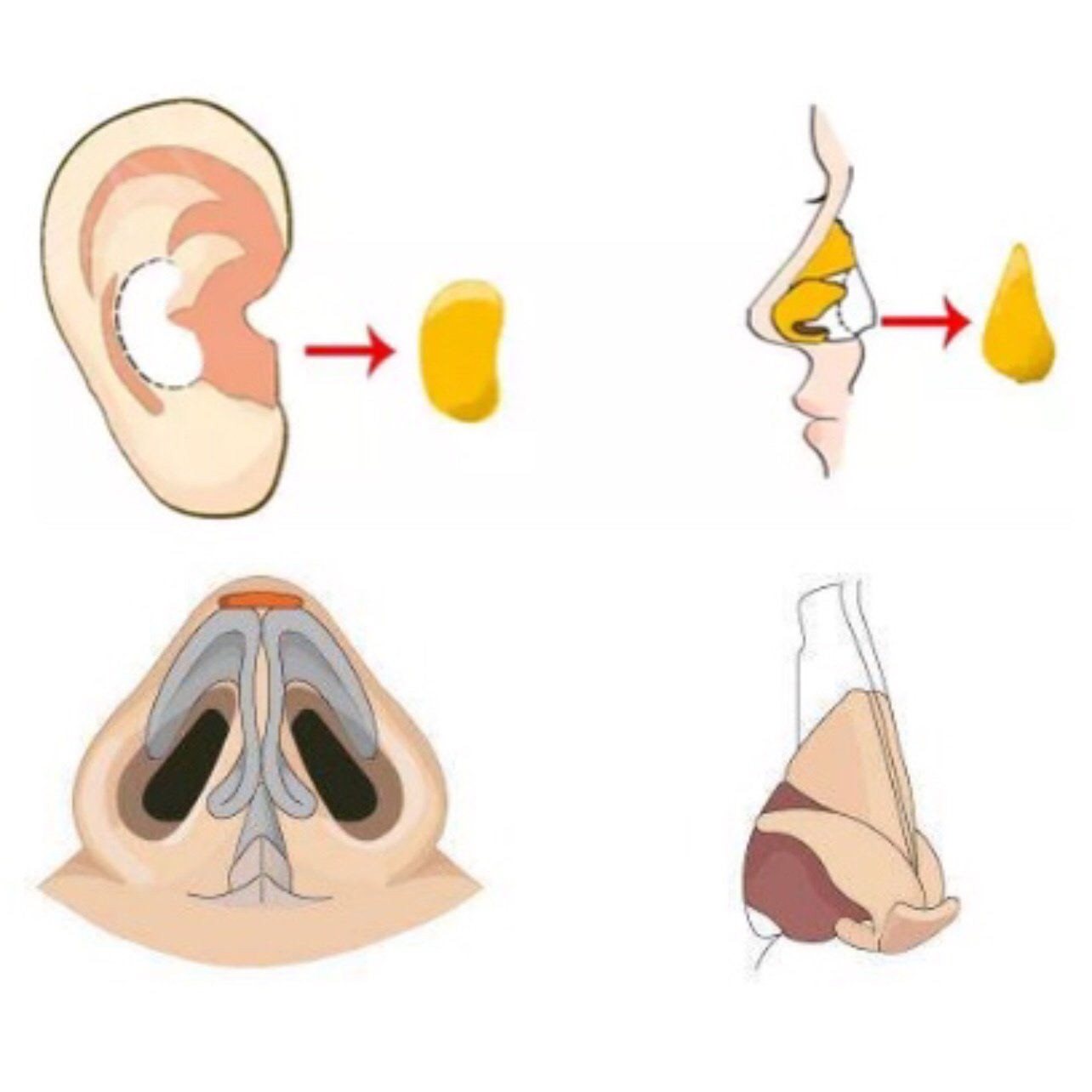 为什么要用耳软骨垫鼻尖