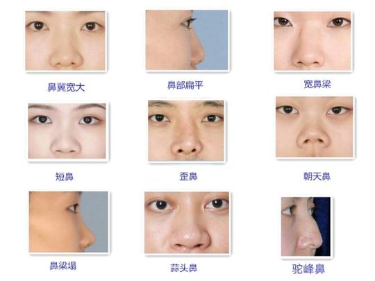 为什么有些宝侧面看起来简直很虐 因为鼻基底凹陷问 圈子 新氧美容整形