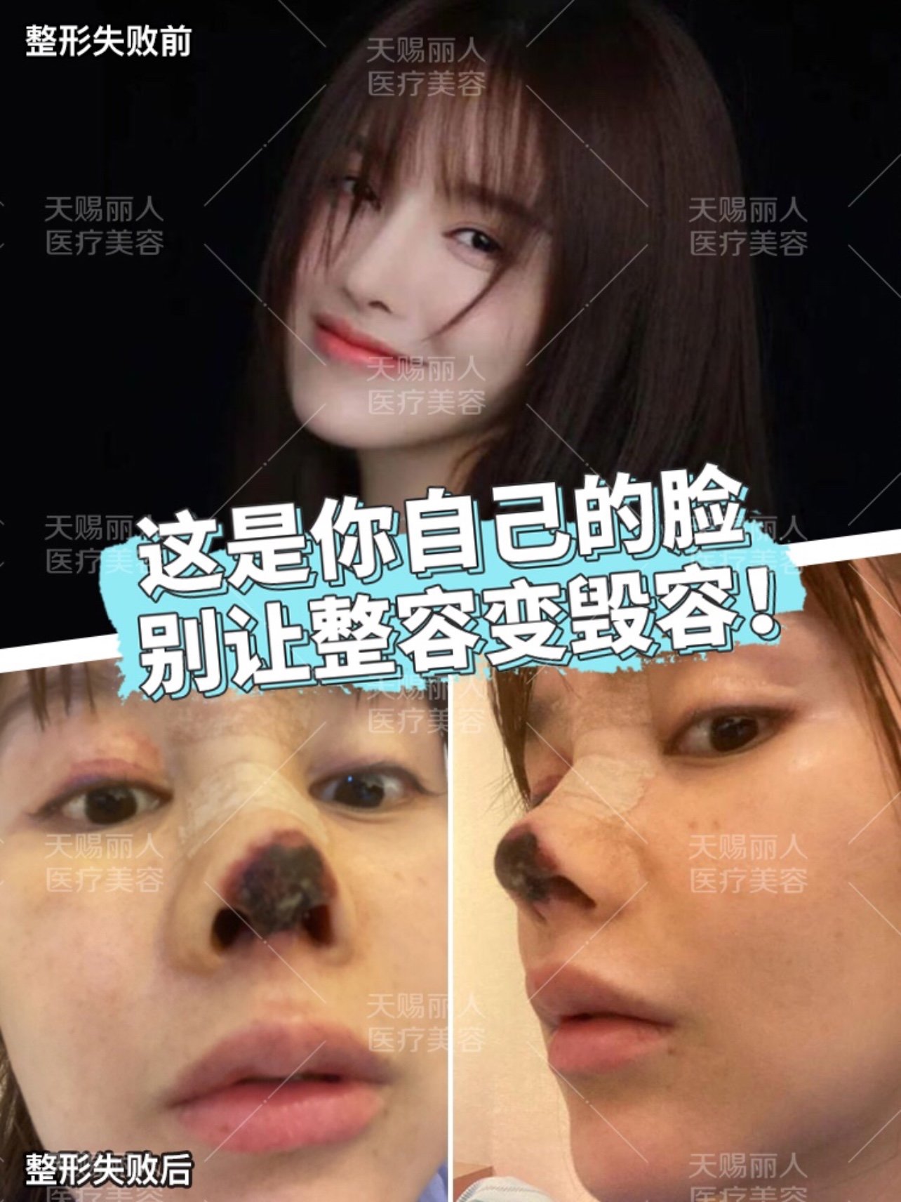 之前演员高溜的事情想必大家还记忆犹新,一次失败的鼻整形手术,让她