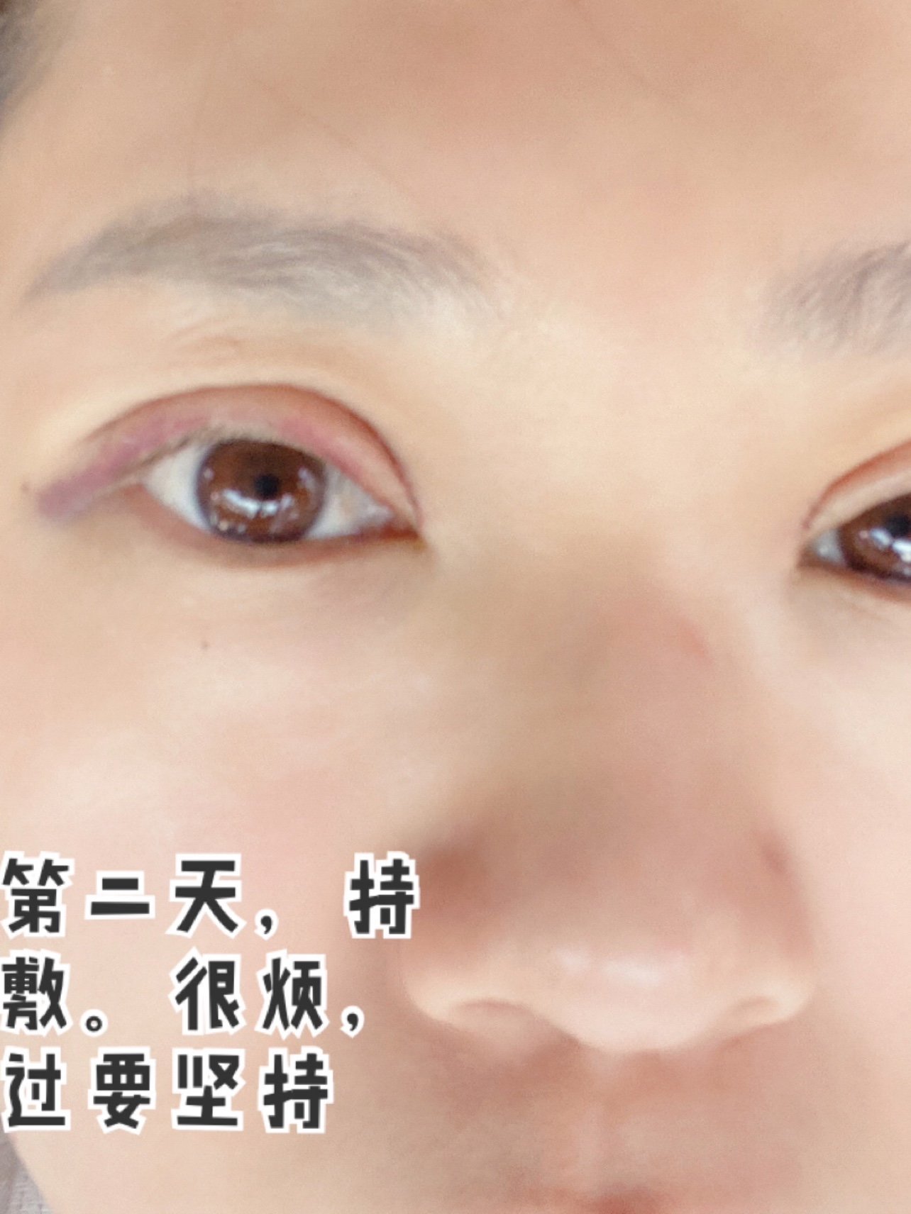4月11日,我是属于内双,贴双眼皮贴的眼皮松弛,眼_圈子-新氧美容整形