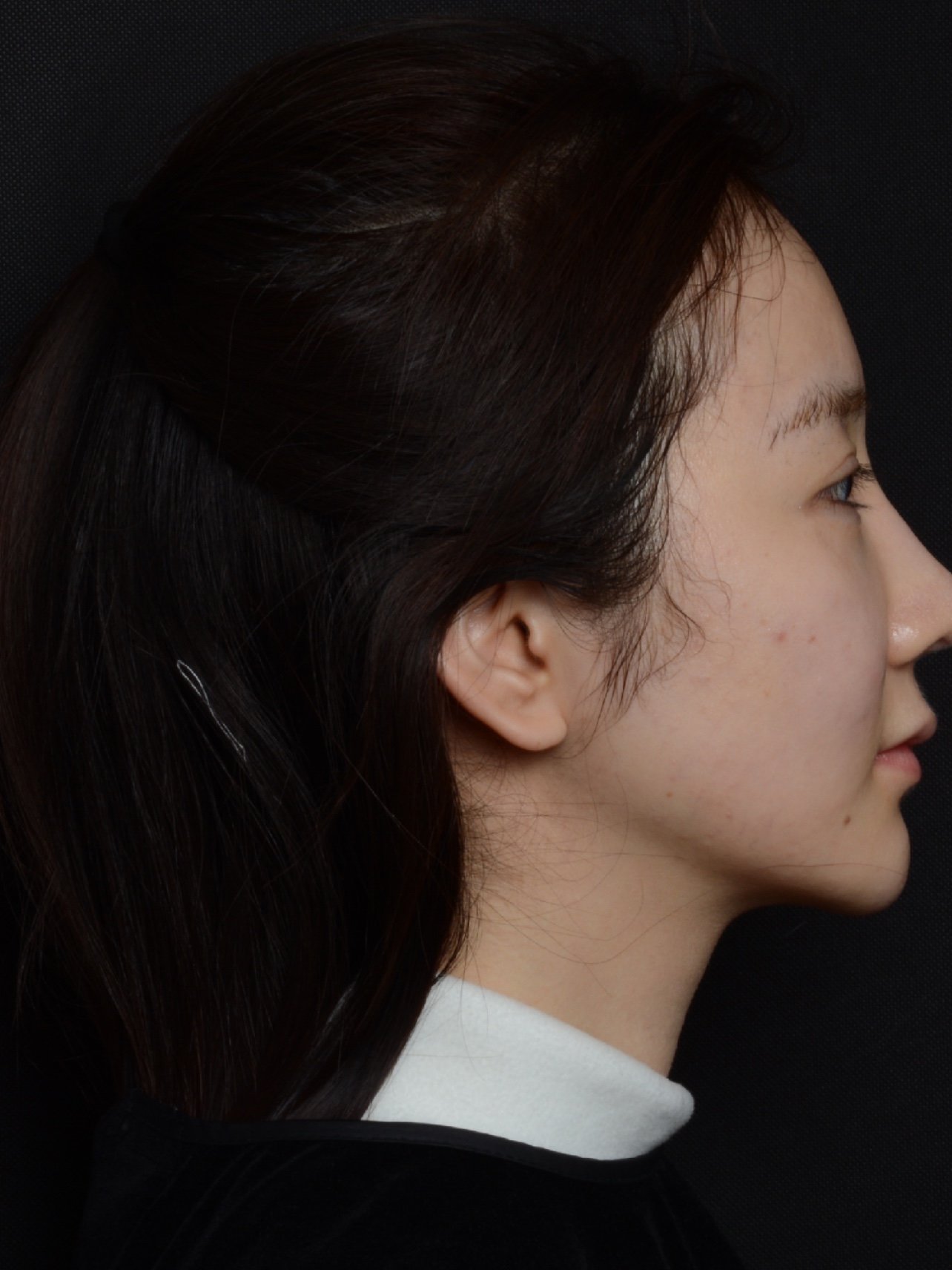 线雕也能塑造清晰下颌线?