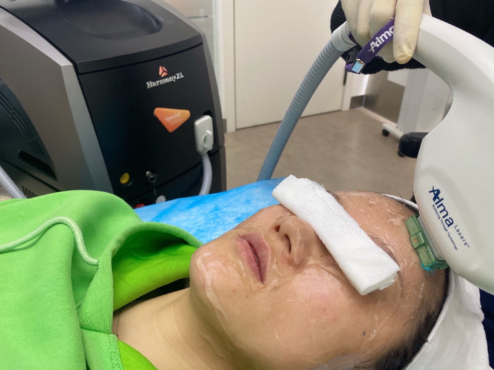 终于下定决心去搞定脸上的斑了之前做了很多功课现在皮秒光子嫩肤什么