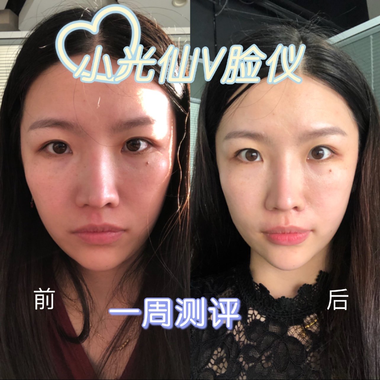 嗨 大家好 我是第92期小光仙v脸仪体验官鞠豆豆 圈子 新氧美容整形