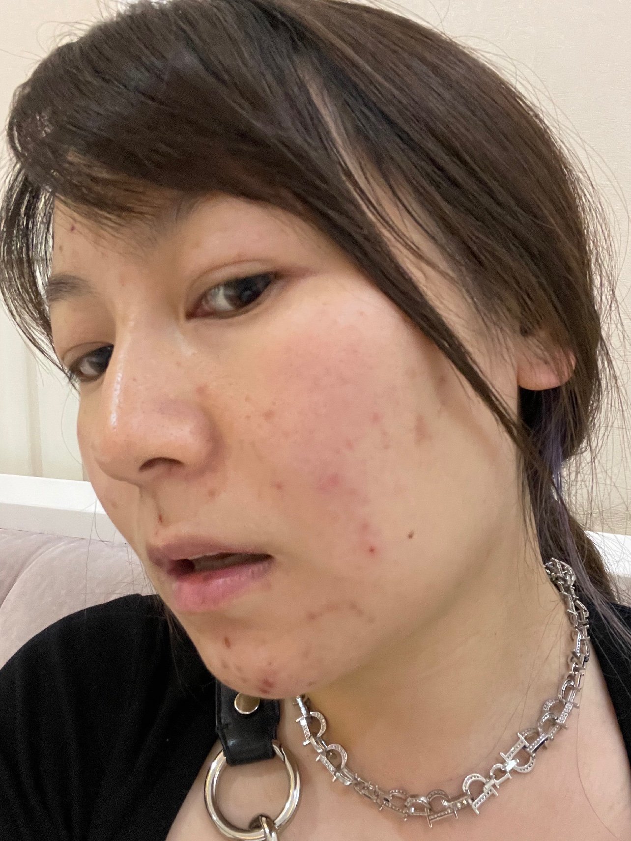 滚针最后两遍_圈子-新氧美容整形