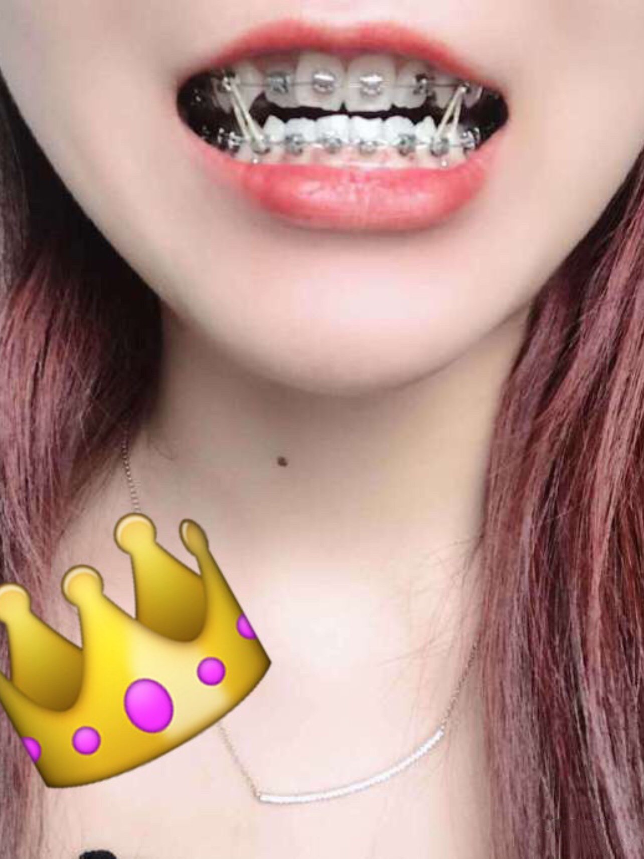 效果总结:两年前跟男朋友分手了,带了牙套来转移注意力,从拔牙开始,到