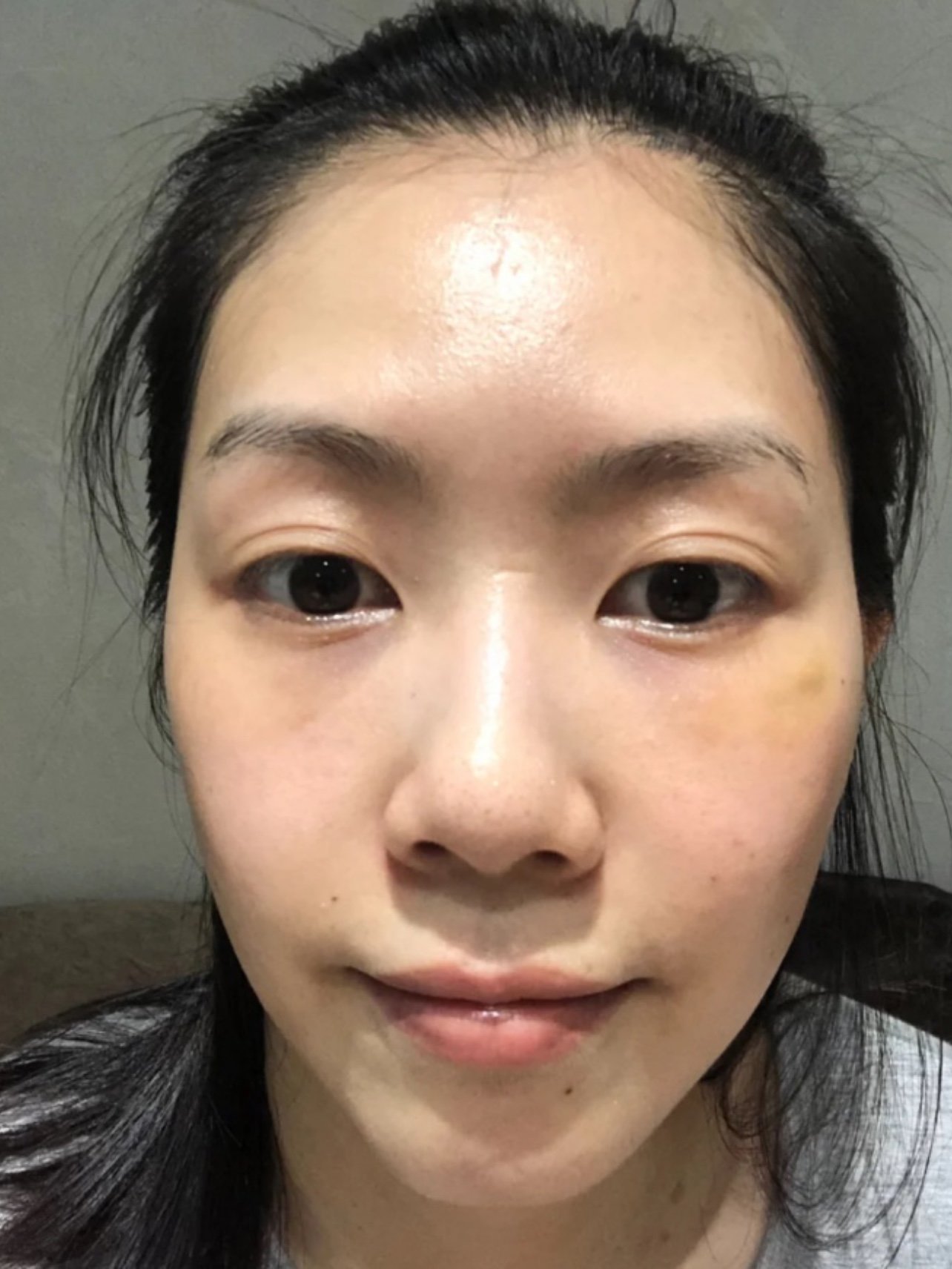 之前在其他地方打的苹果肌玻尿酸,打得太僵硬了,一直_圈子-新氧美容