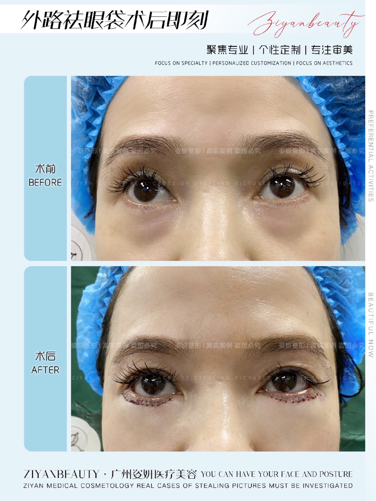 姿妍医美外路祛眼袋术后即刻