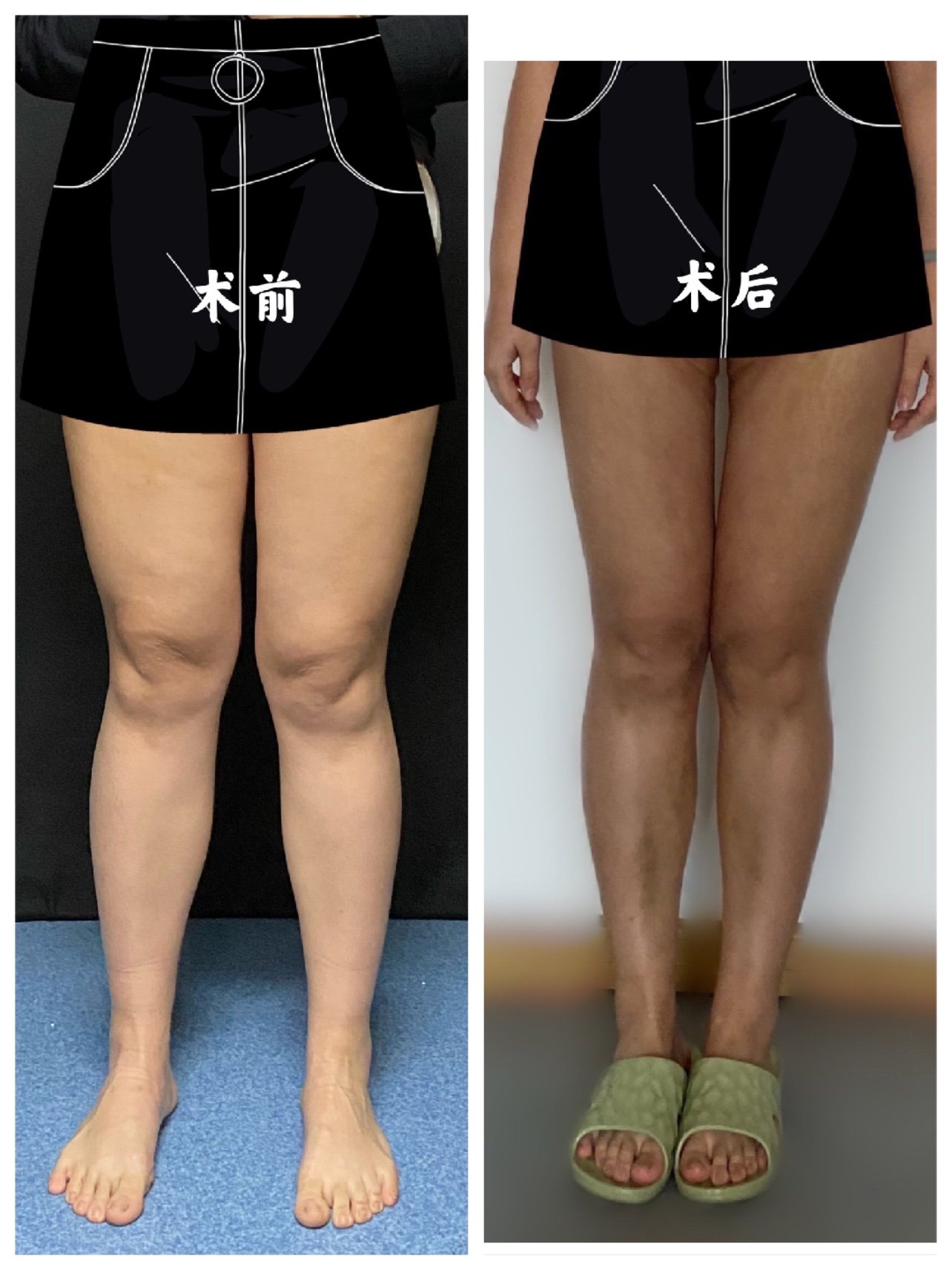 大腿环吸不知不觉一个月啦!