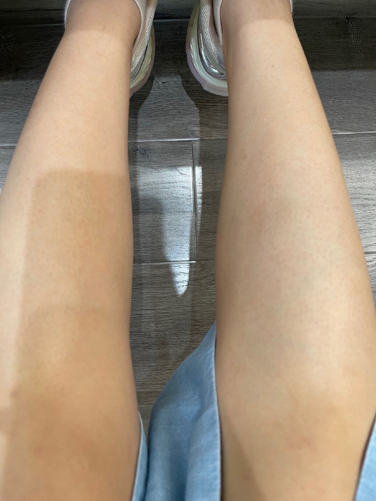 [:163]体验前变美诉求:原本腿部皮肤粗糙,膝盖_圈子-新氧美容整形