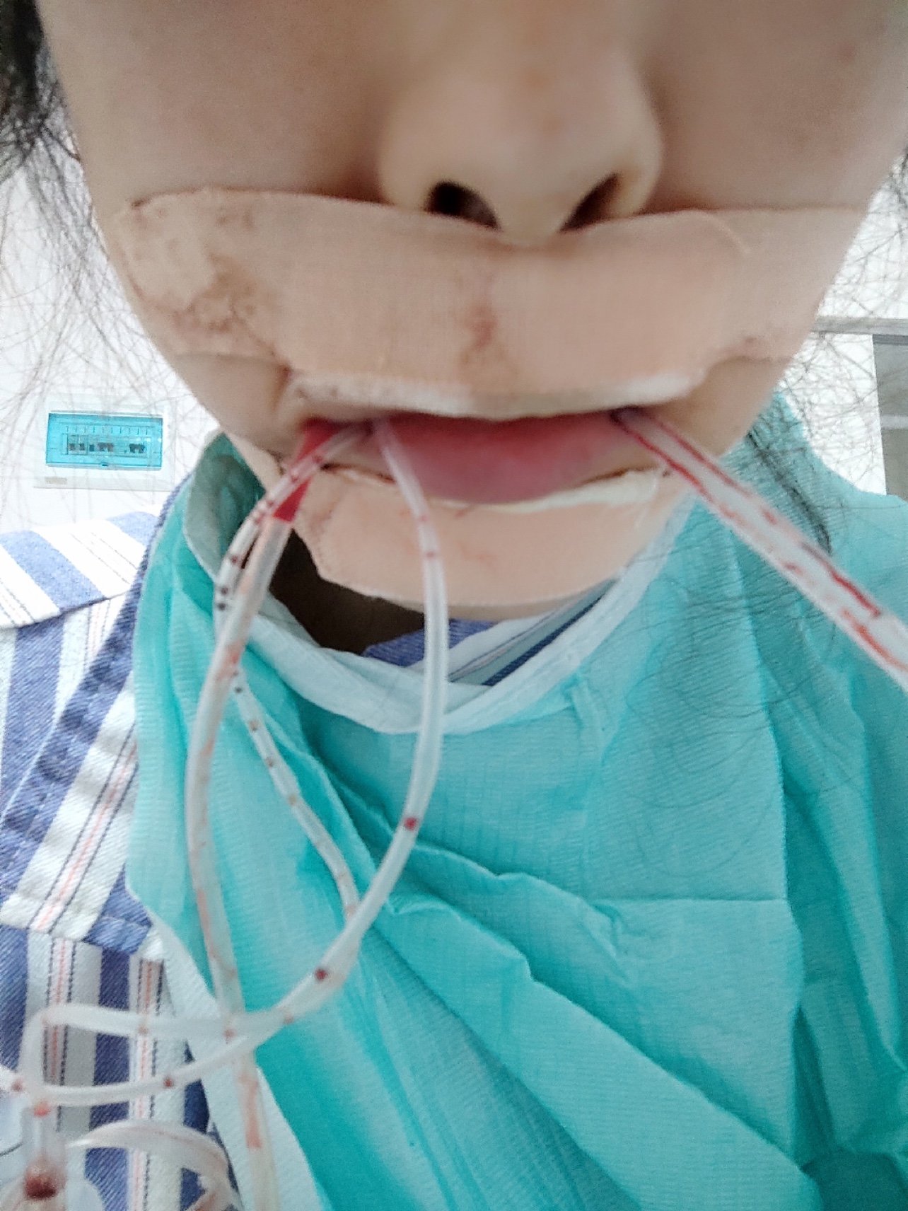 凸嘴露龈笑手术后第一天并没有睡好,因为上下颌都做了_圈子-新氧美容