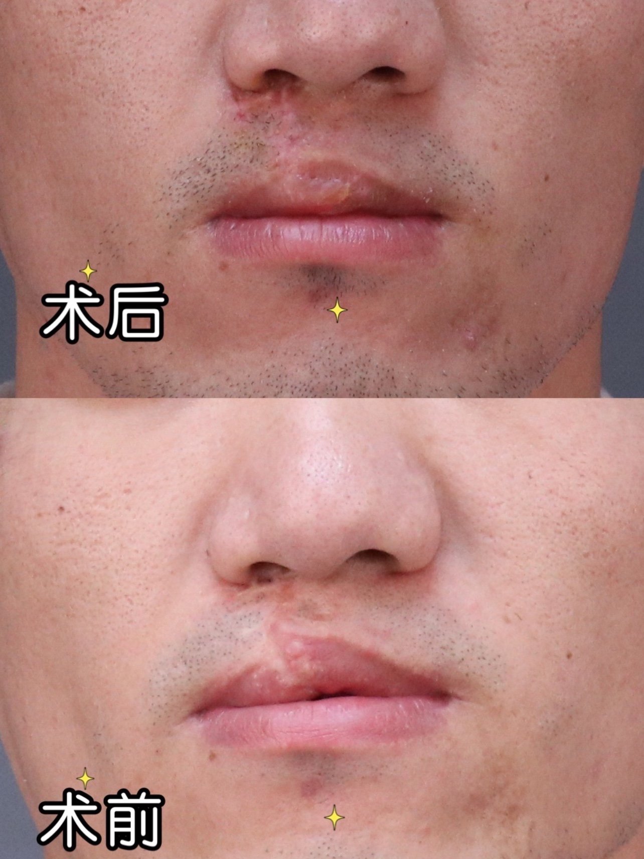 每个唇腭裂都是被上帝吻过的天使