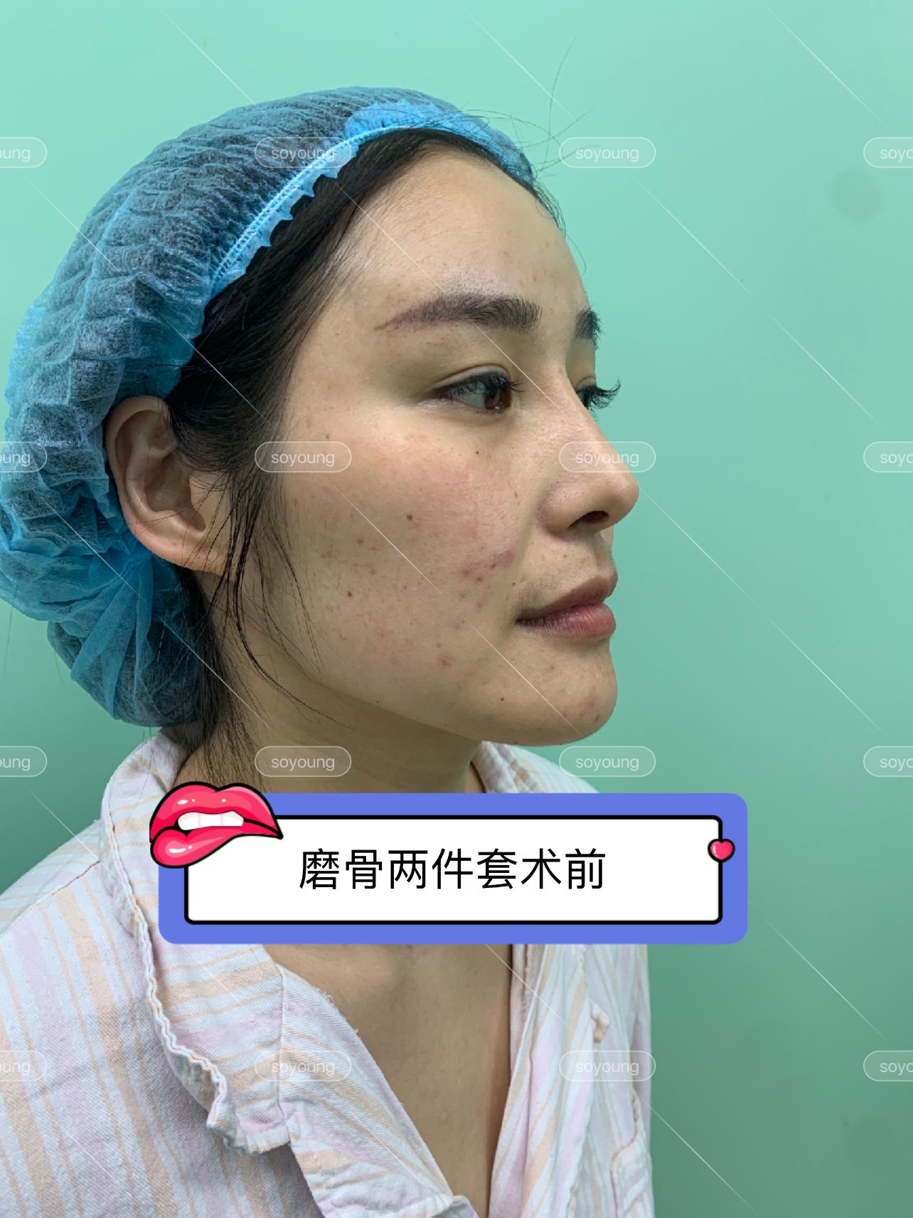 磨骨轮廓两件套术前术后即刻对比