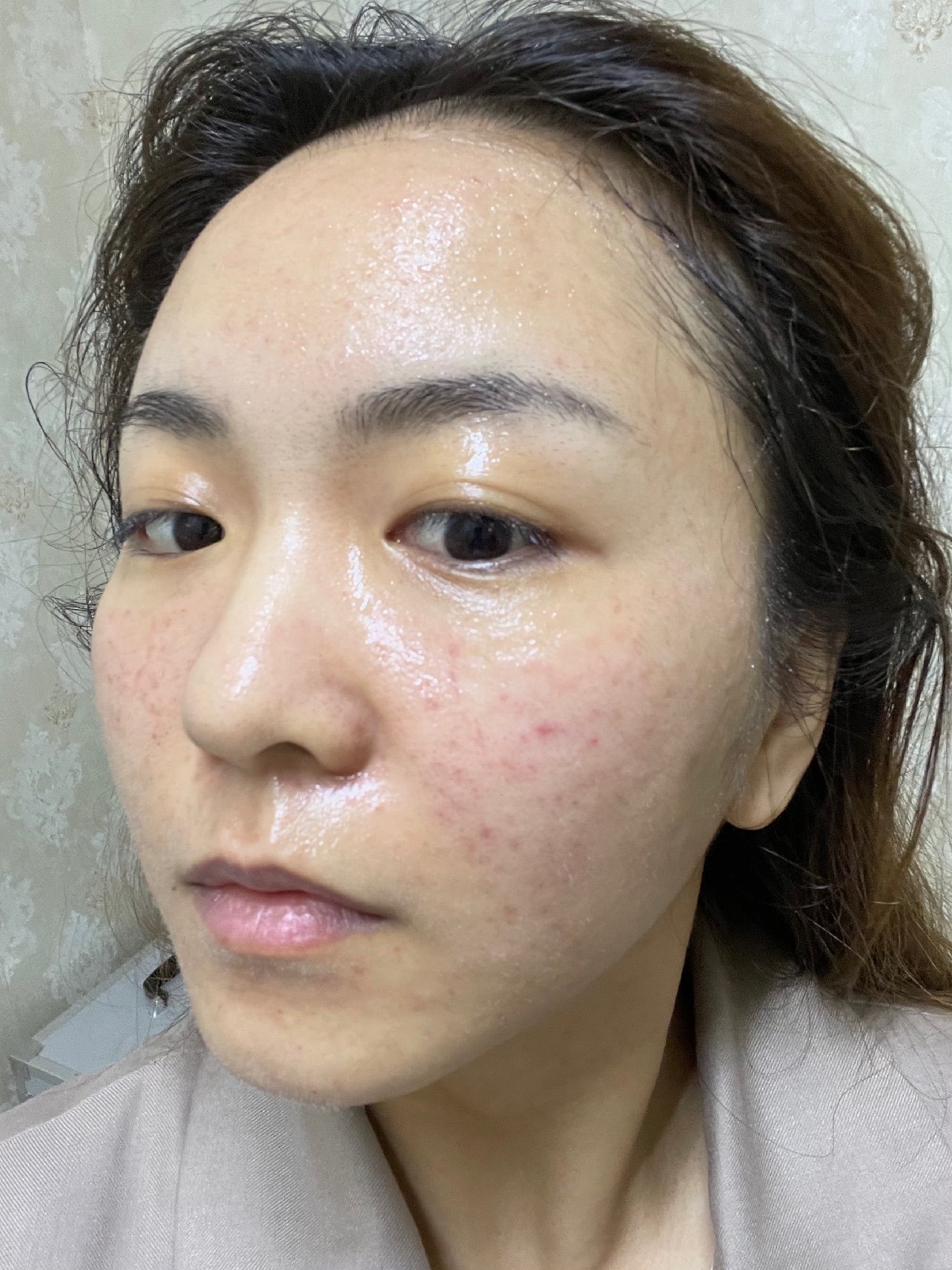 韩佳人水光做完已经很久了赶紧来记录一下变美过程