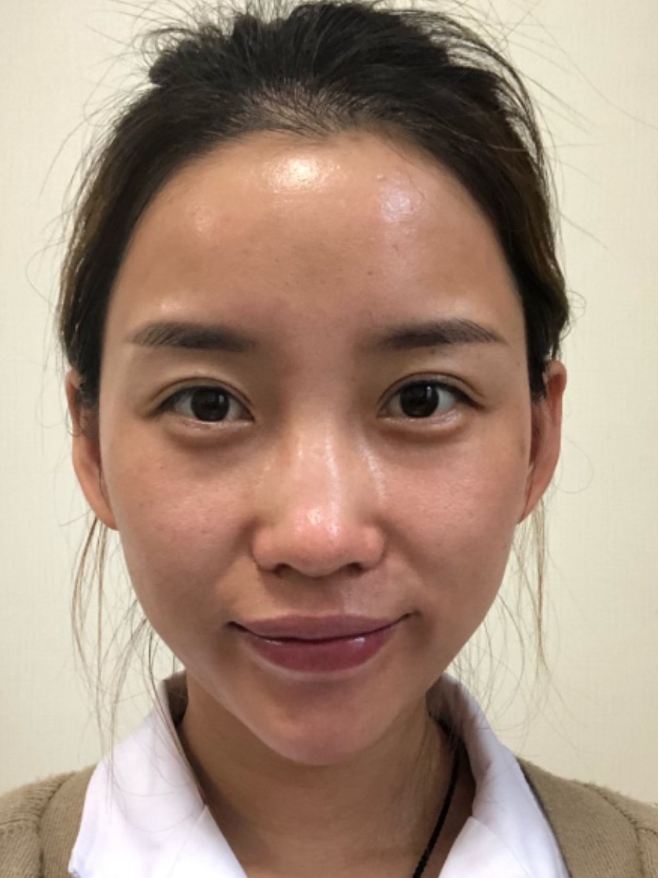 皮肤暗沉,粗糙,毛孔明显