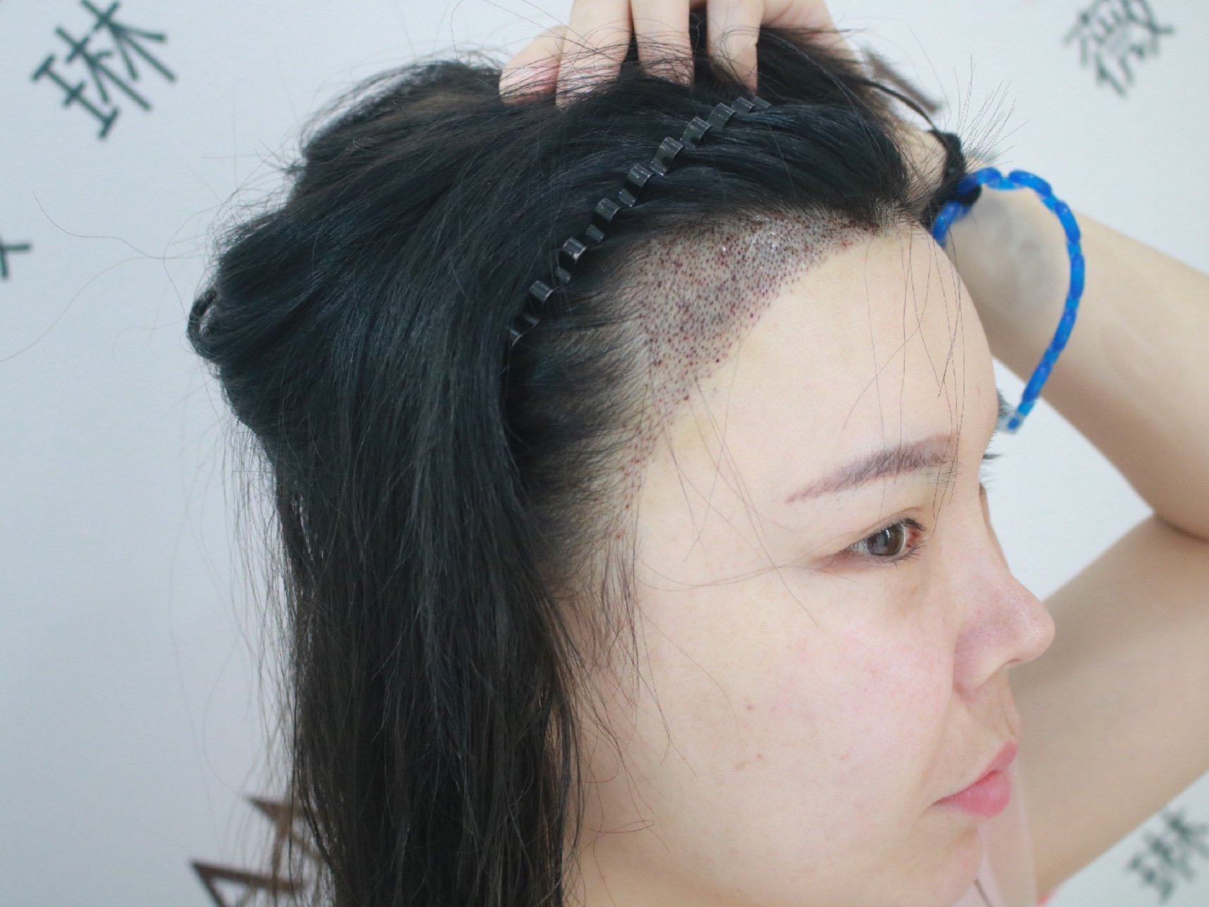 额角高,想要圆形发际线柔和五官,降低高发际线带来的年龄感,修饰面部