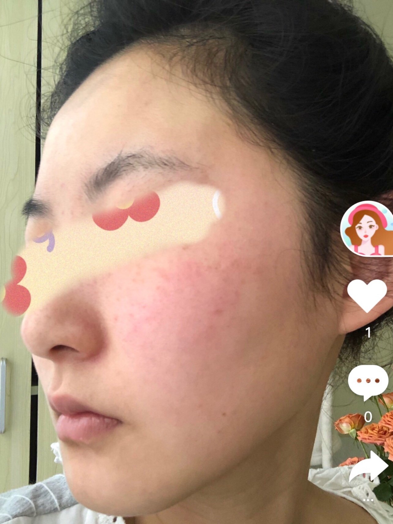 体验后效果:光子嫩肤第七天打卡啦!