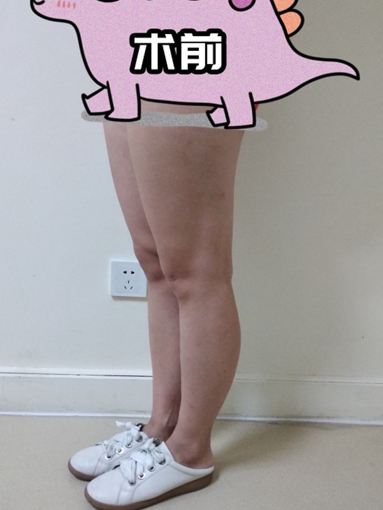 大腿 多维水溶吸脂/可升级5g天使光/脂肪平铺技术/紧致提升/不穿塑身