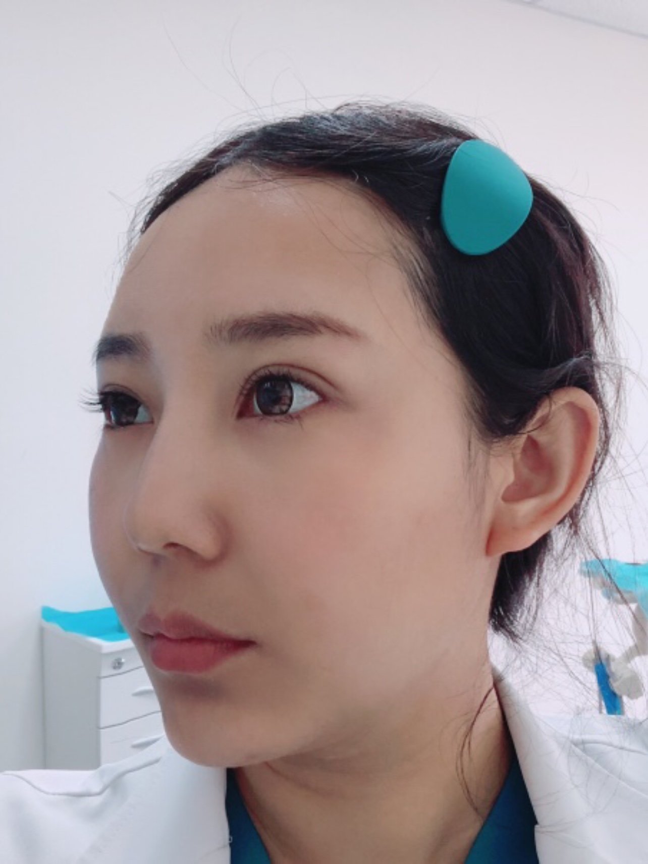 双下巴面部吸脂第22天