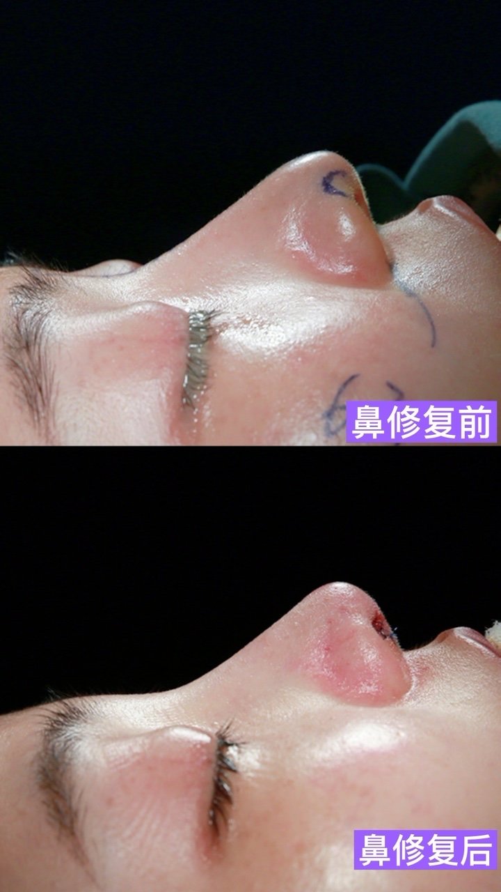 求美者几年前在韩国做的隆鼻手术,现在出现鼻背凹陷,_圈子-新氧美容