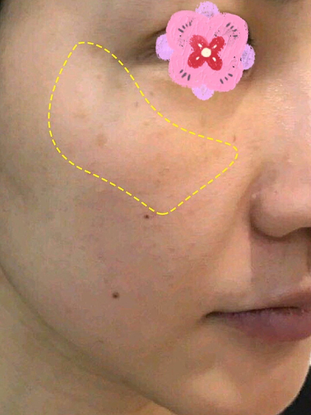【光子嫩肤】m22光子嫩肤王者之冠 淡化痘印/红血丝/敏感肌/美白嫩肤