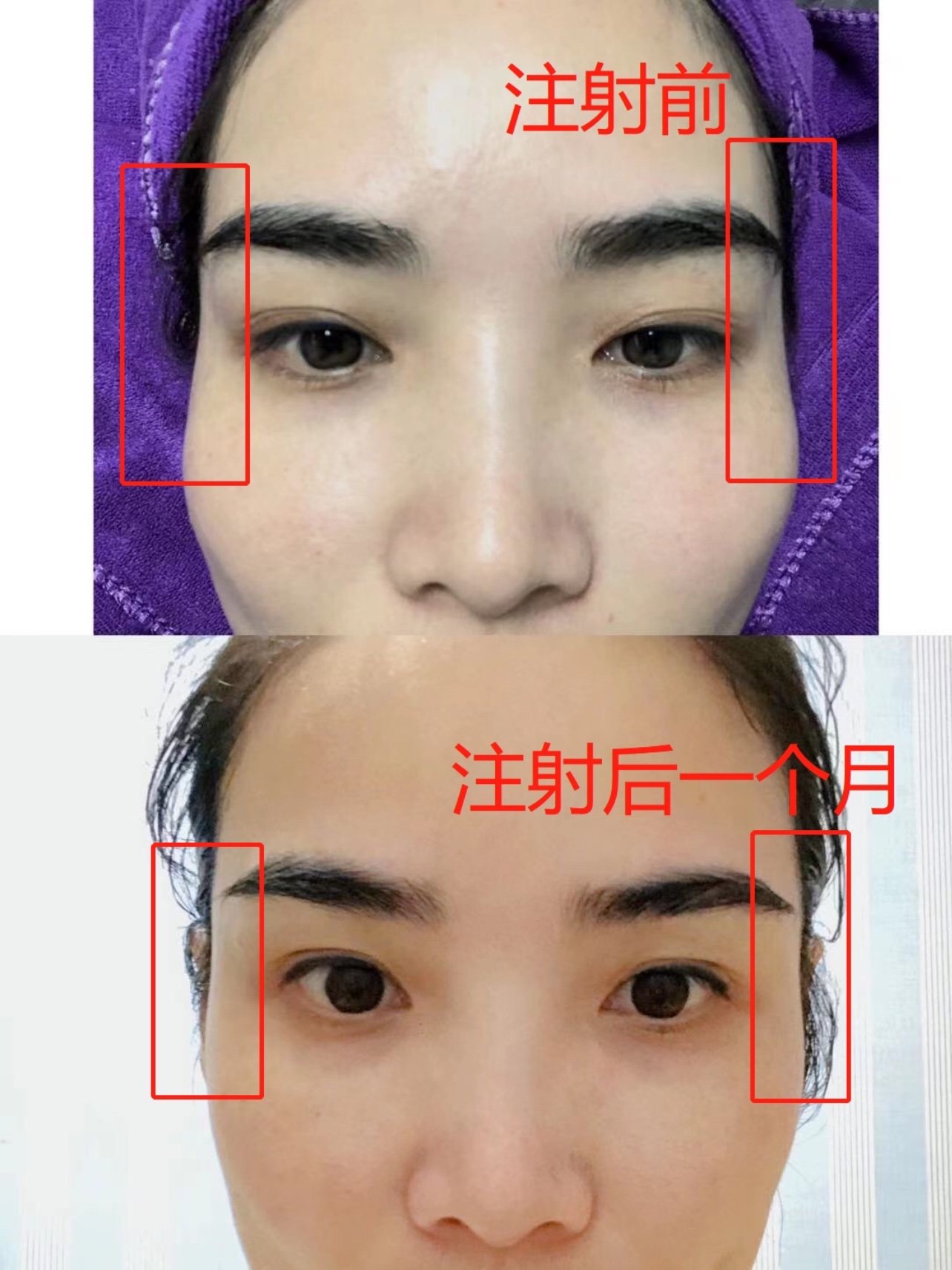 新氧体验官艾莉薇风尚玻尿酸 太阳穴填充一个月效果反馈