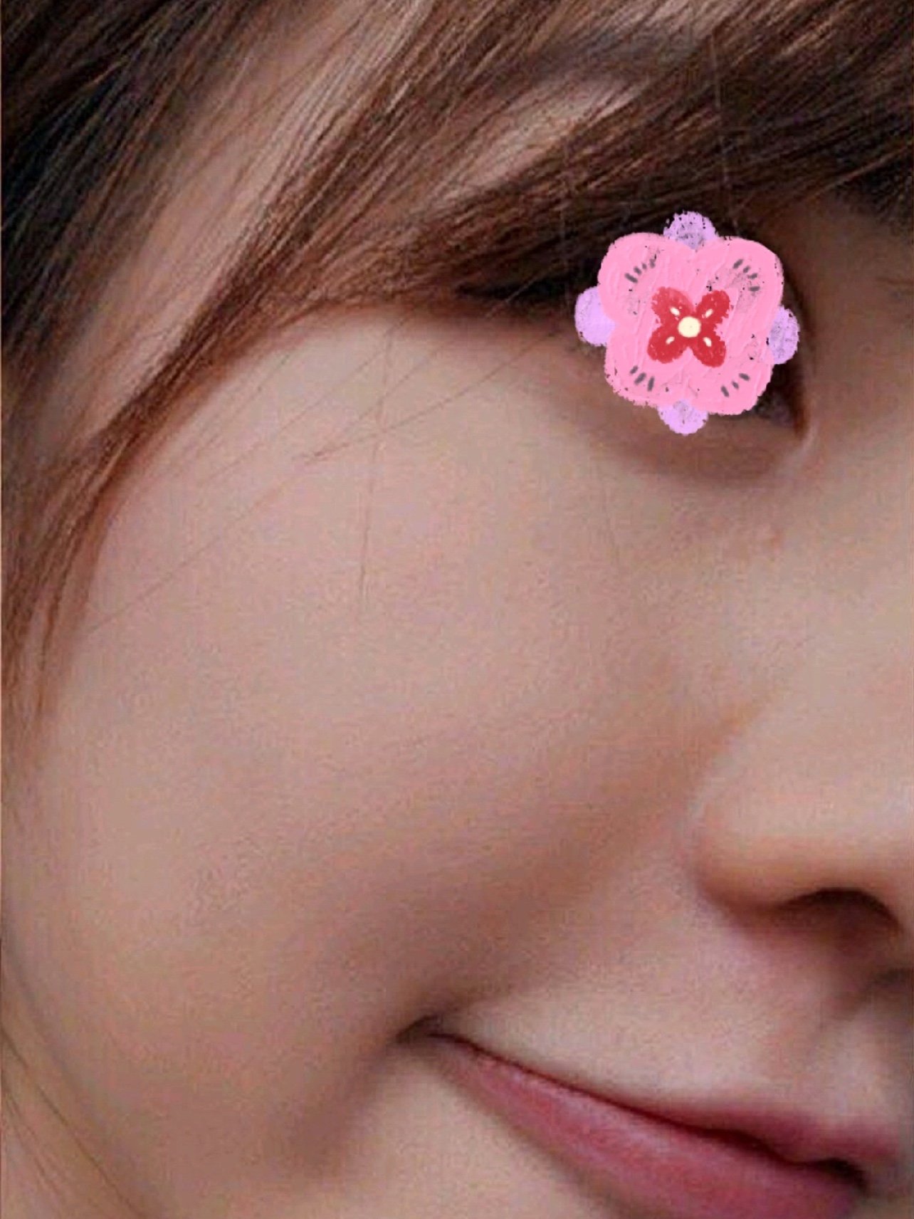 【光子嫩肤】m22光子嫩肤王者之冠 淡化痘印/红血丝/敏感肌/美白嫩肤
