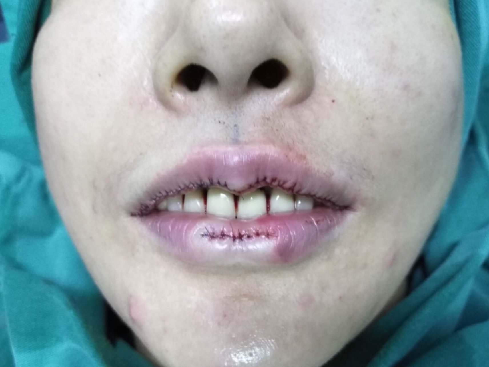 把嘴巴做了,厚唇改薄77下唇pp唇.