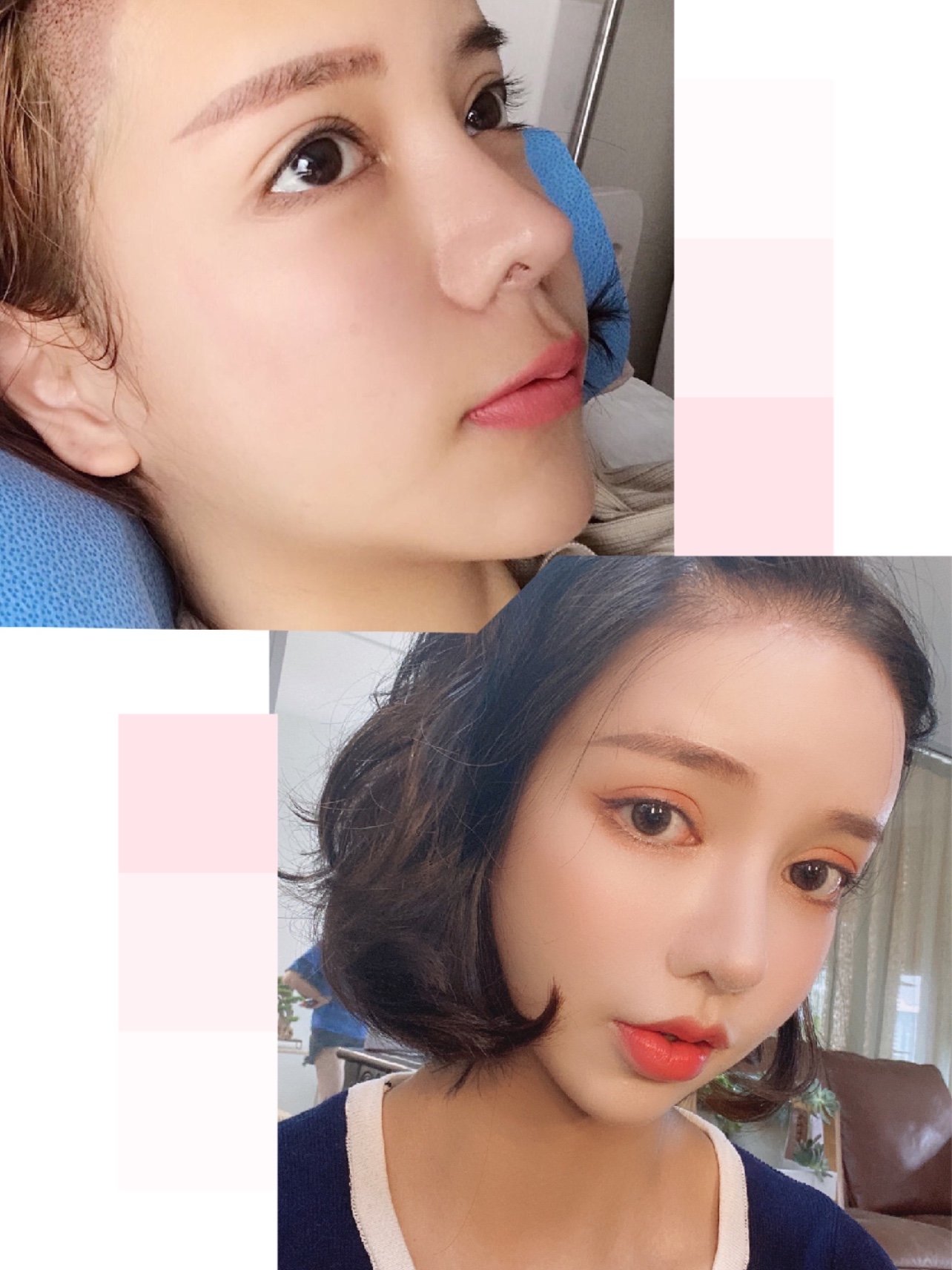 人中缩短77人中沟加深手术医生:余若晖手术_圈子-新氧美容整形