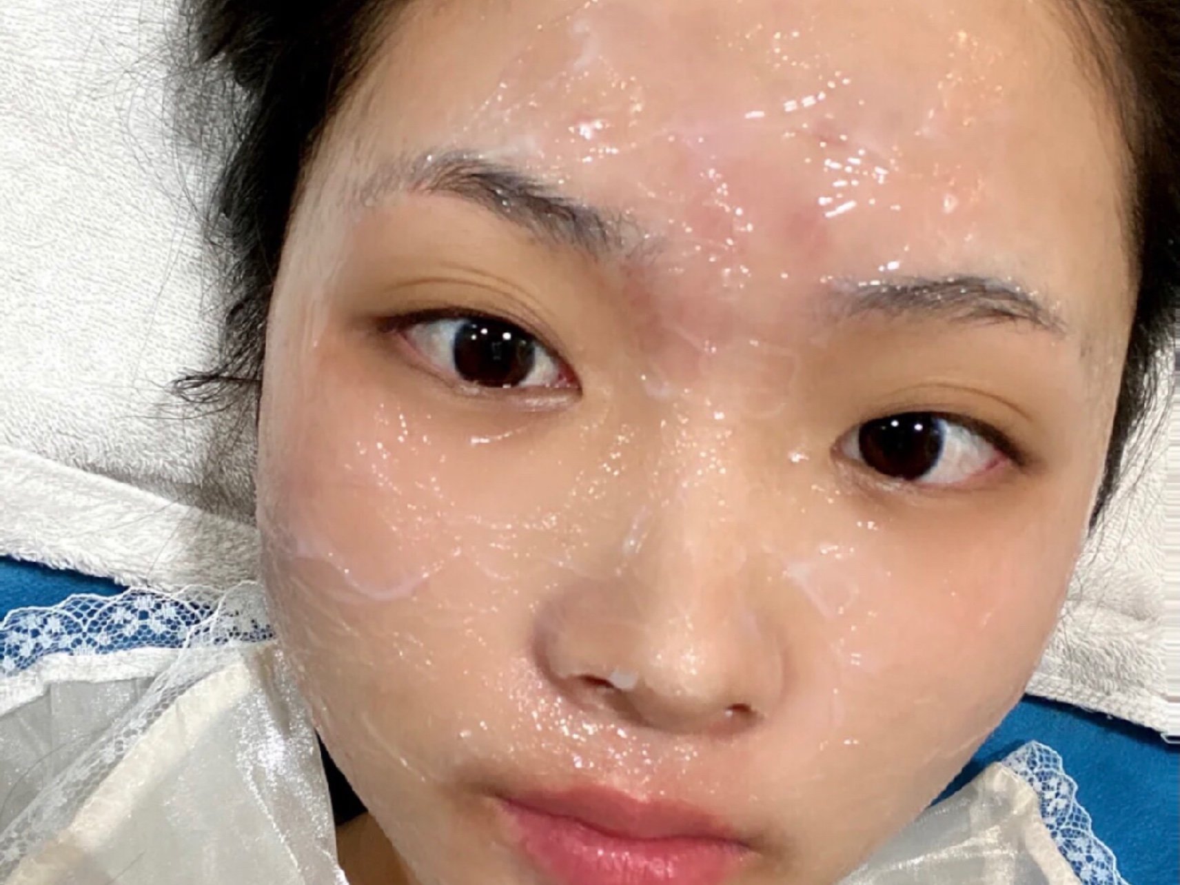 做完微针已经三天了,原本上个月就要做了,了解到微针_圈子-新氧美容