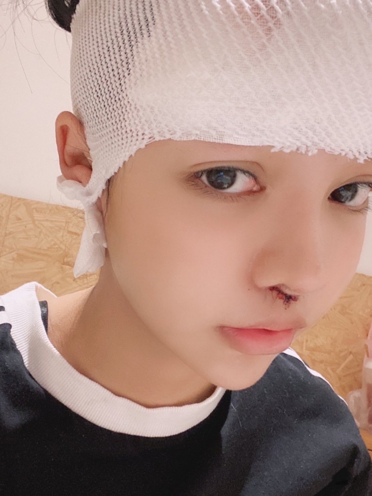 人中缩短77人中沟加深术后第2天