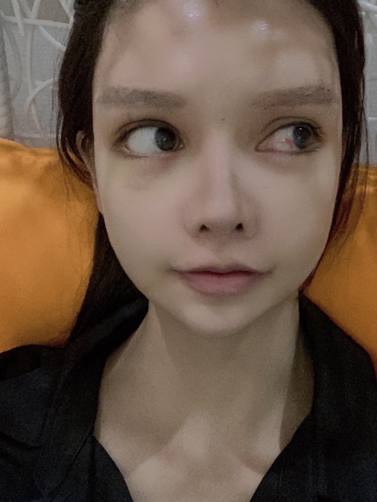 0303手术项目:射极峰膨体眉弓77假体眉心0303手术医院_圈子
