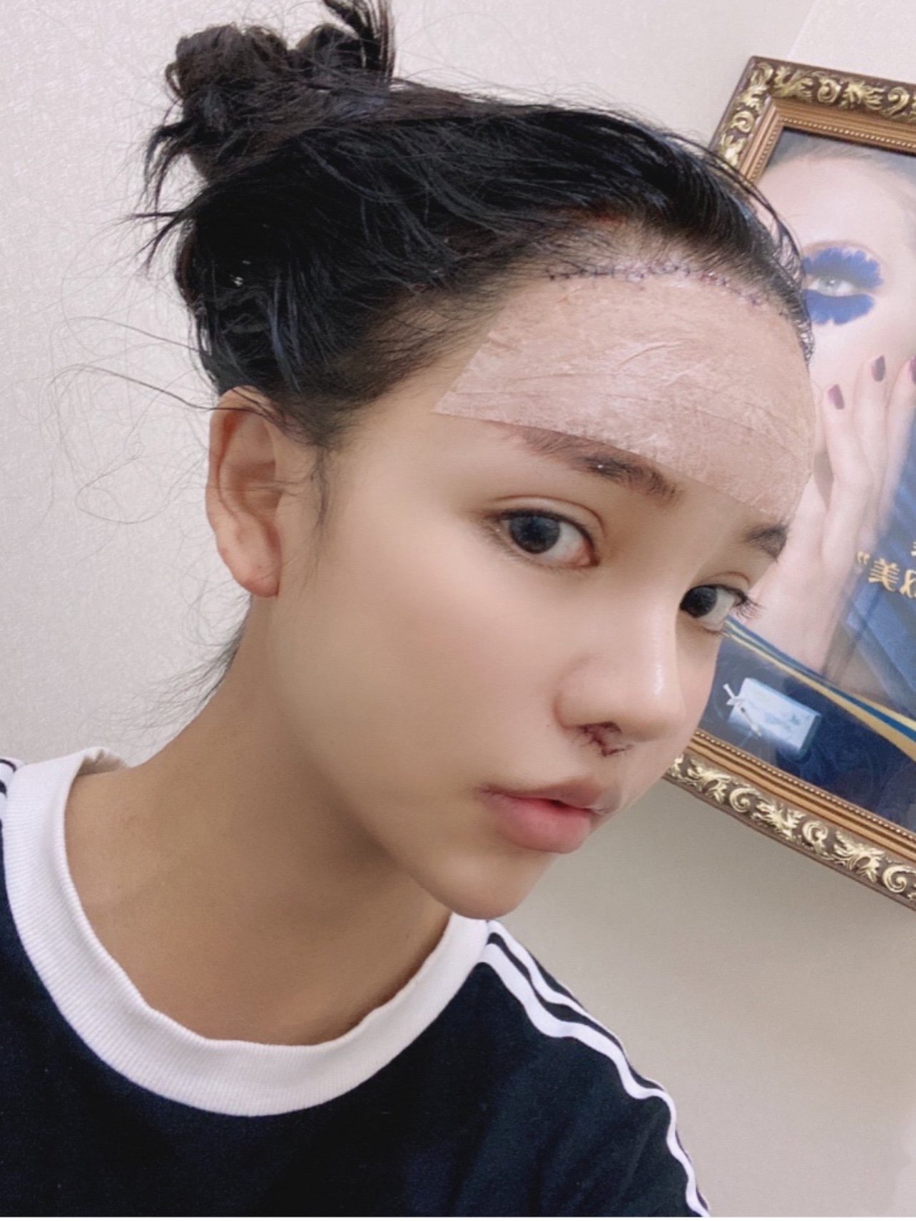 人中缩短77人中沟加深术后第2天