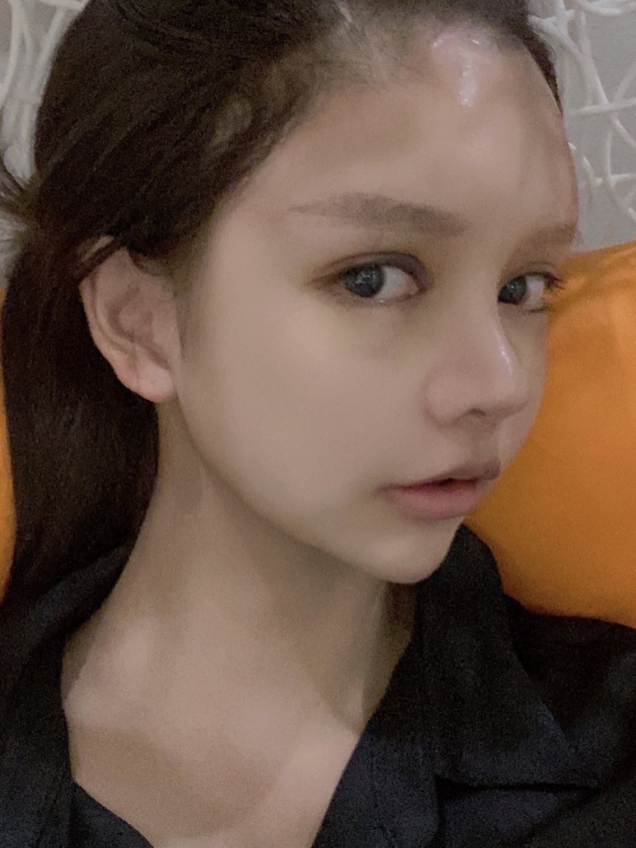 手术项目 : 射极峰膨体眉弓假体眉心