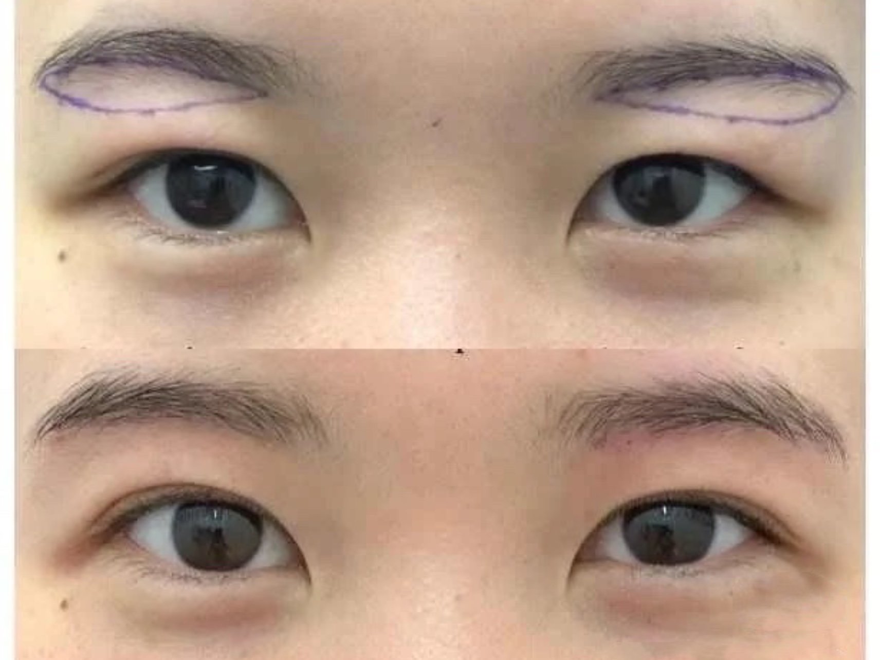 我是天生的眼皮比较松弛,上眼皮脂肪厚,看起来非常臃_圈子-新氧美容