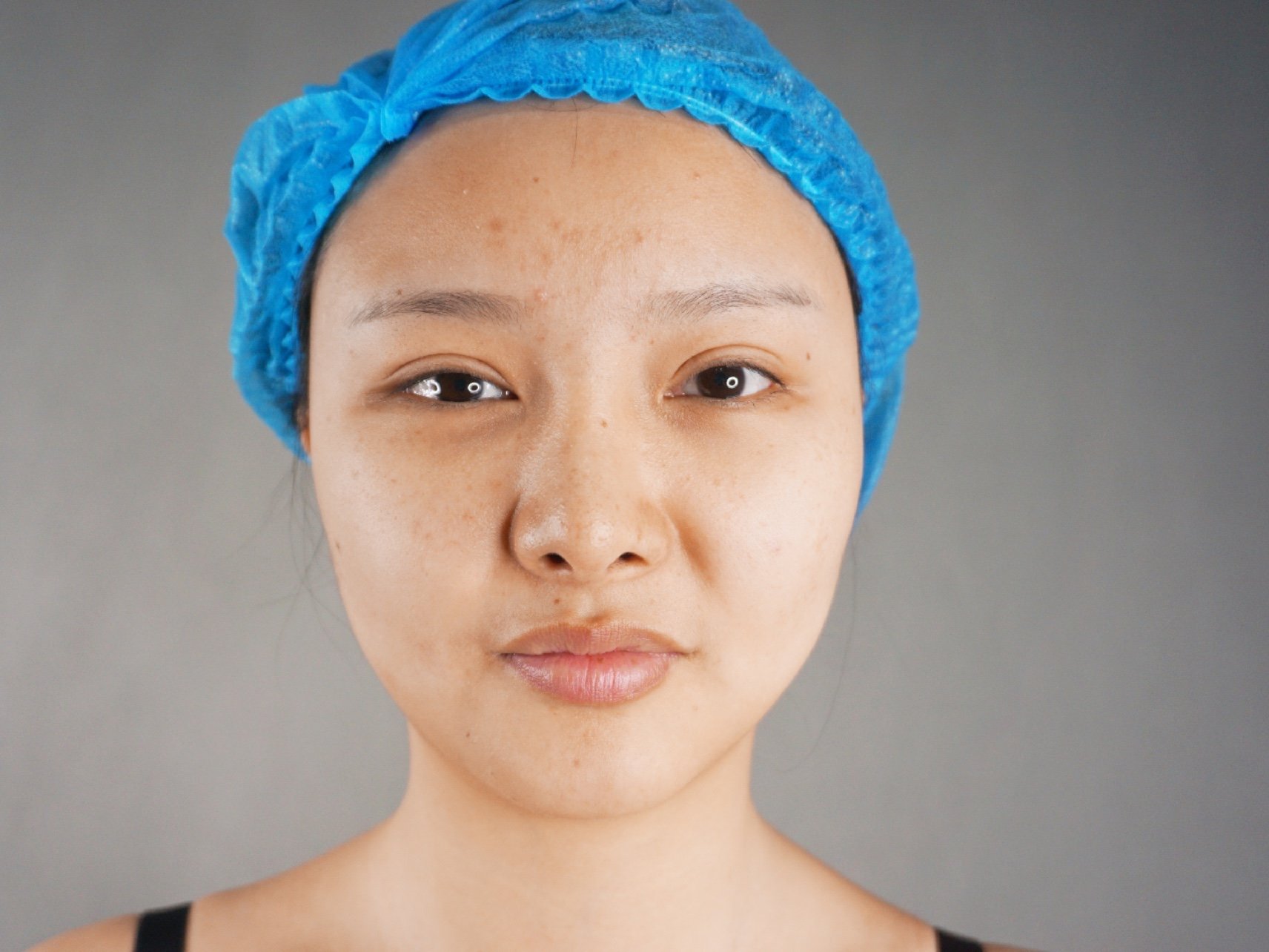 99术前诊断:93脂肪堆积型脸大,脸宽,视觉比腰腹和大_圈子-新氧