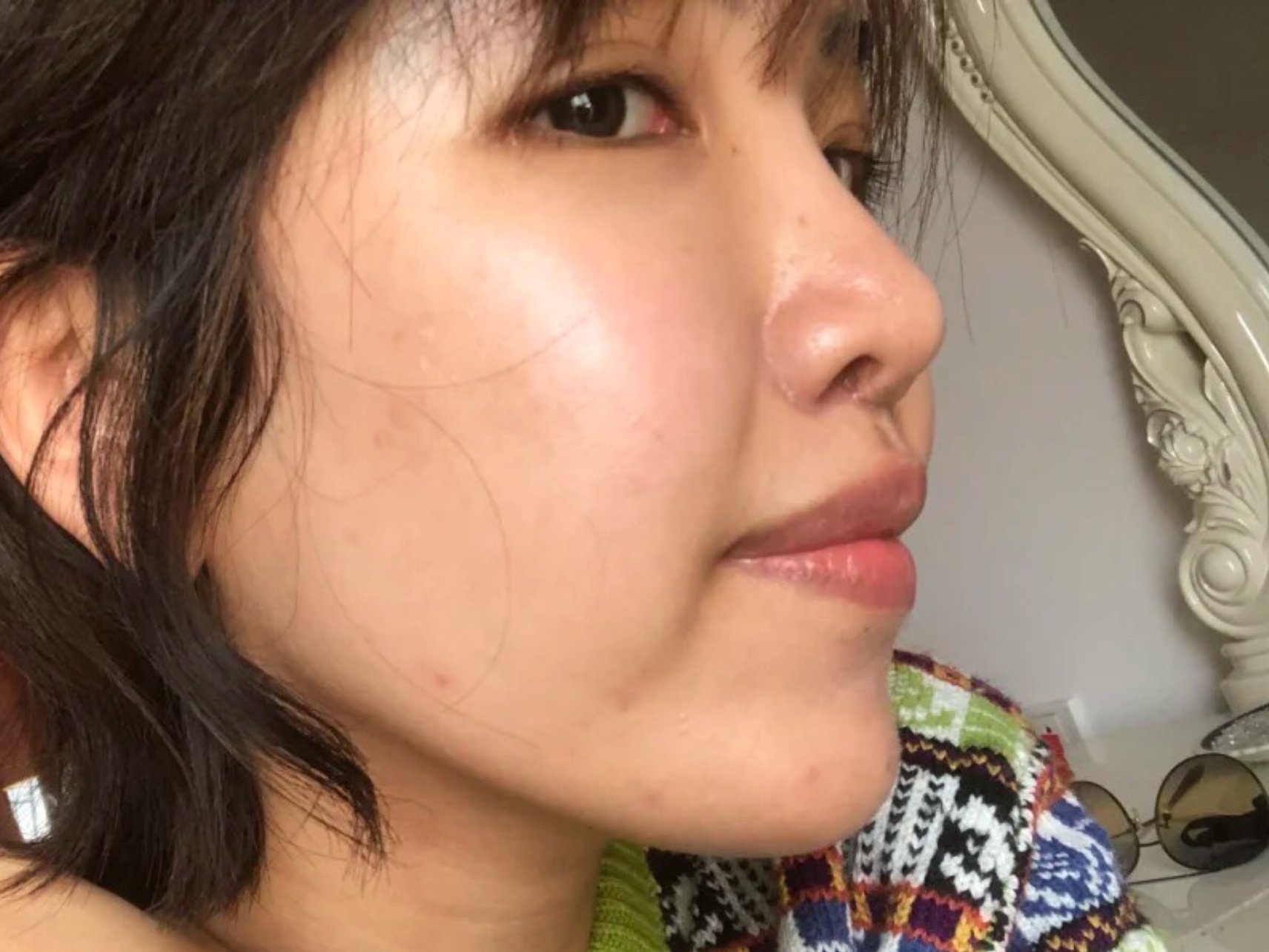 人中术前术后对比