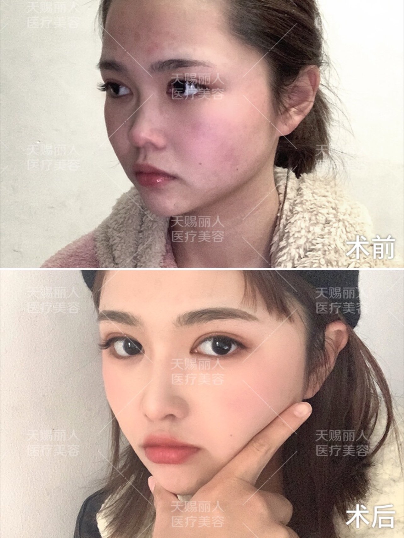 统一鼻整形审美的鼻子长什么样?鼻梁篇