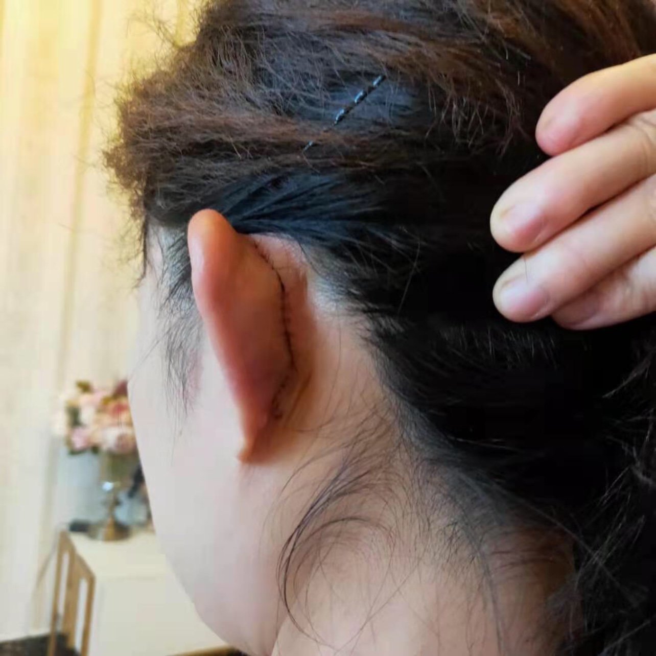贴发耳术后10天,还没拆线,正面看效果很满意.有人_圈子-新氧美容整形