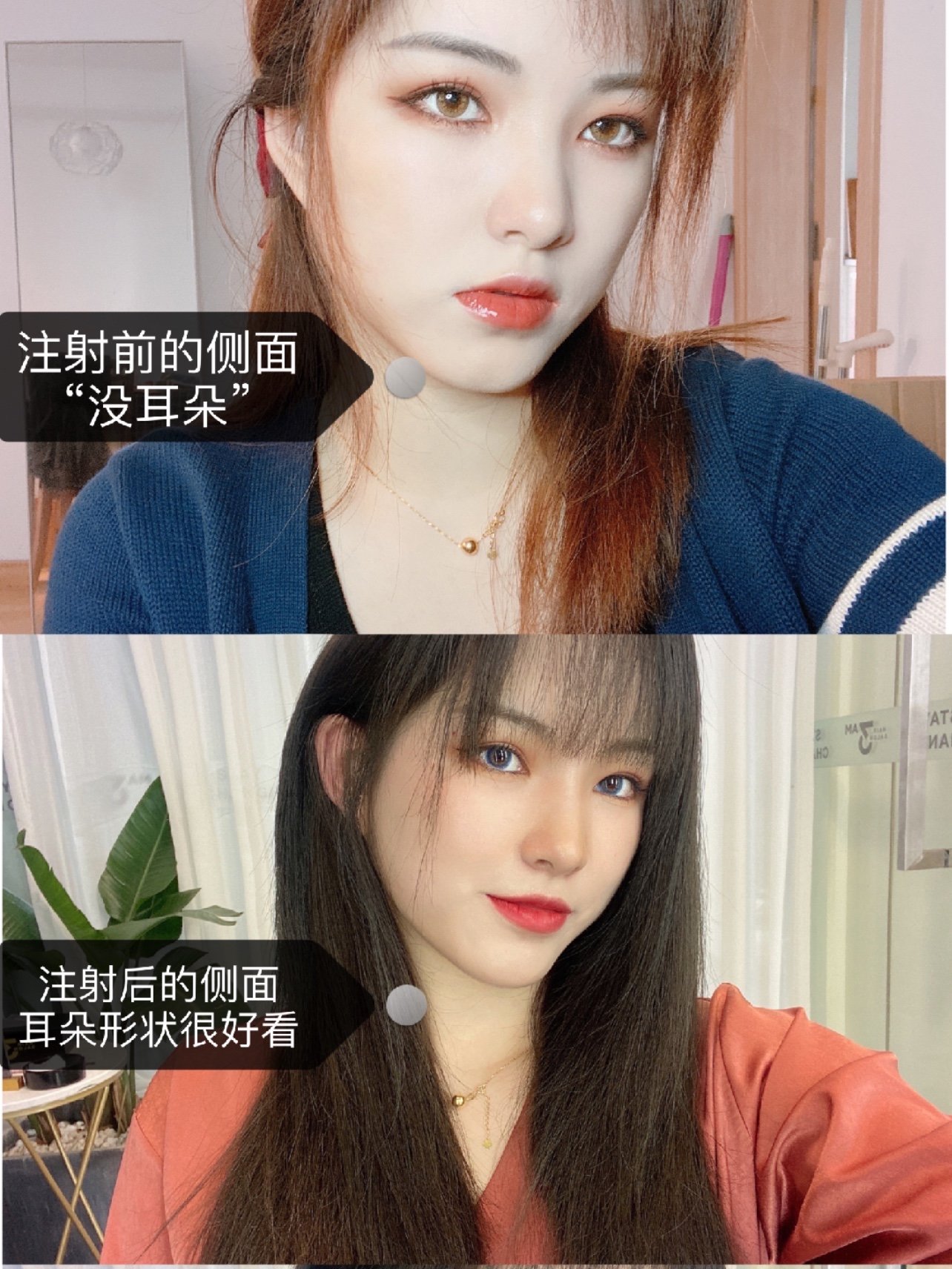 "精灵耳"注射一个多月了,到底有啥用?这么多玻尿酸_圈子-新氧美容整形