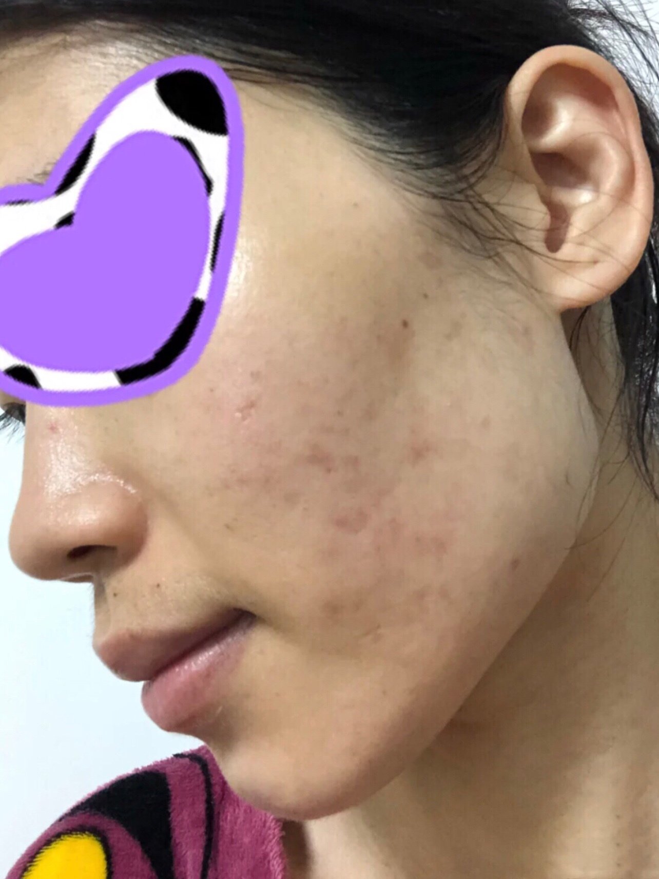 光子嫩肤第23天,我的天!照镜子左右脸颊痘印肉眼可_圈子-新氧美容整形