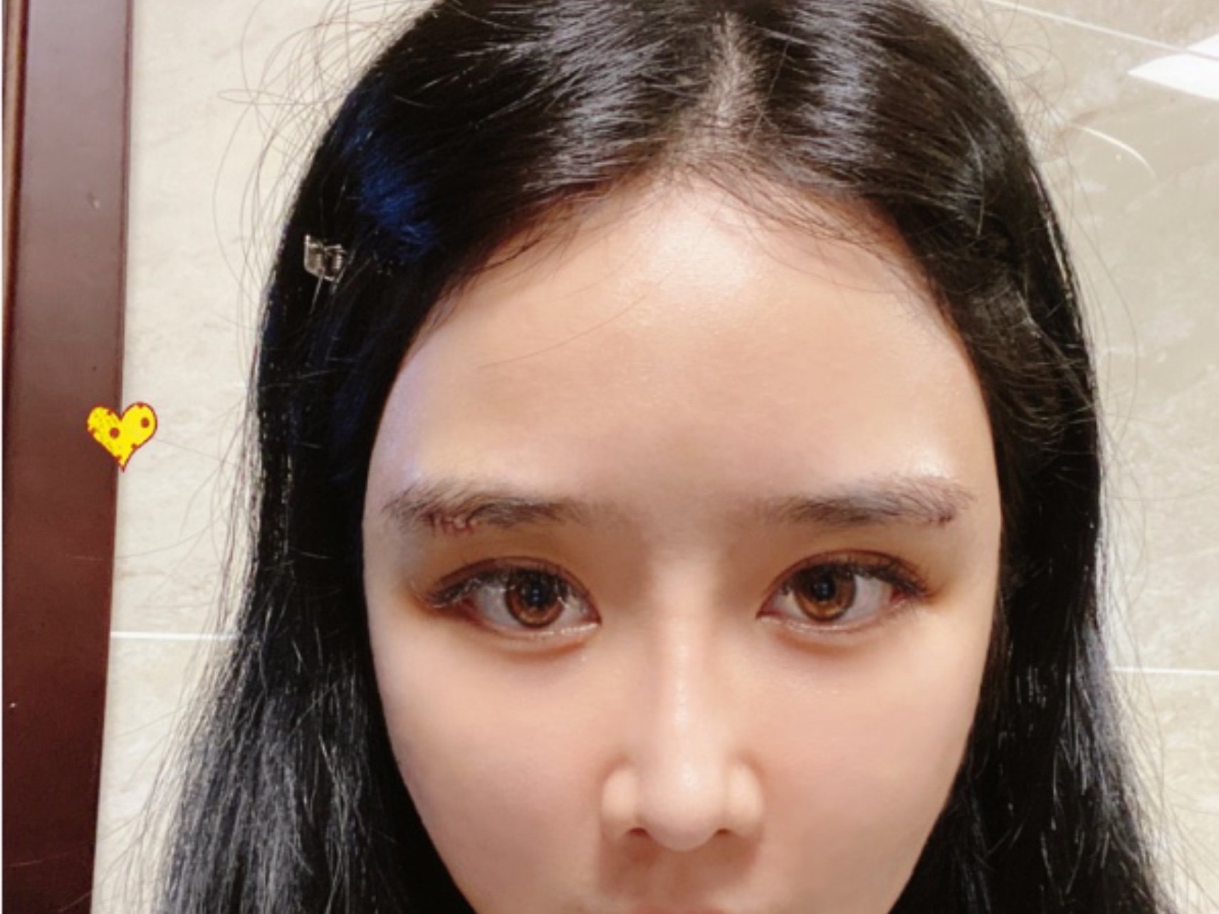 做完假体垫眉弓的第四天了,还是很肿,现在眉弓的地方_圈子-新氧美容